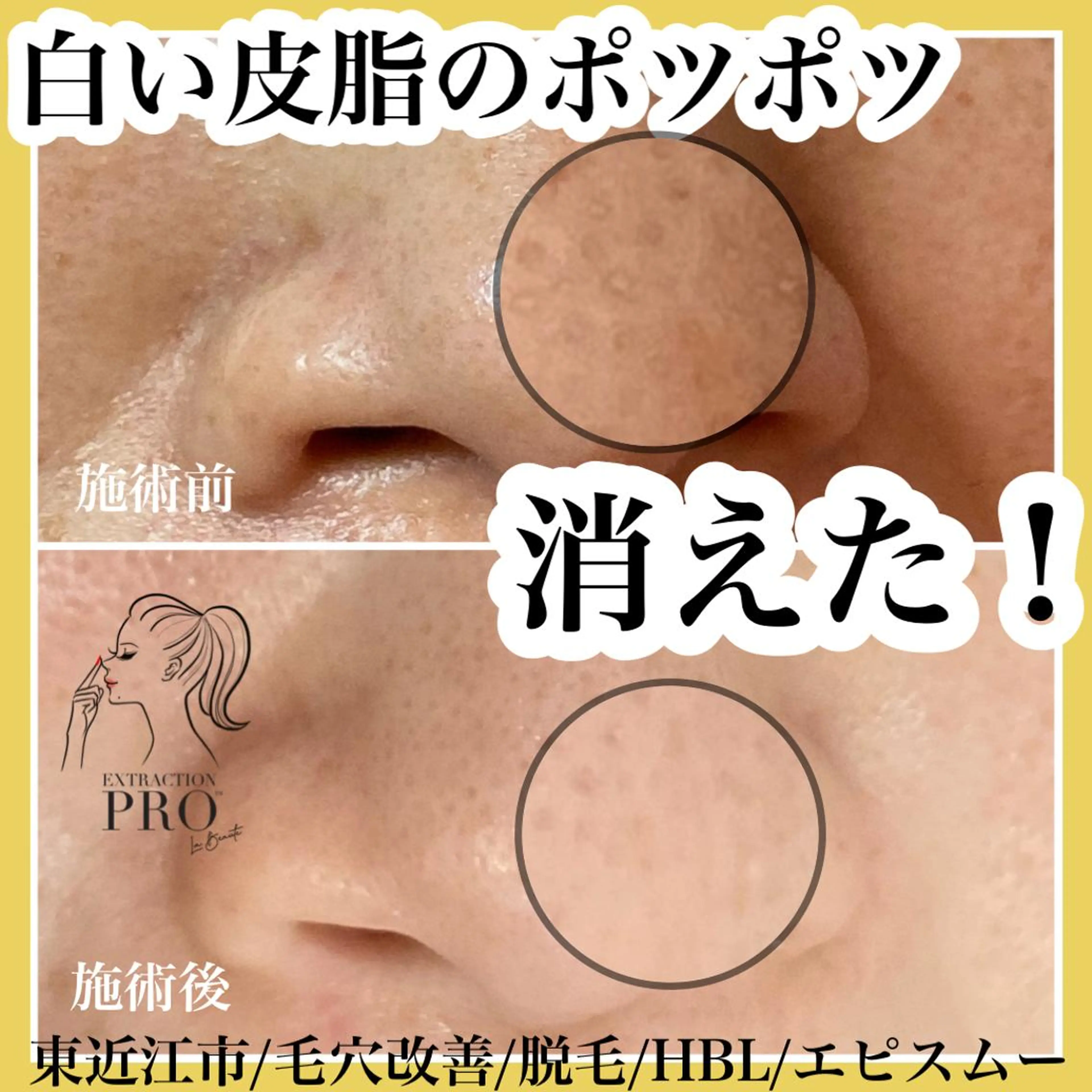 epismoo 脱毛/HBL/毛穴の眉毛・アイブロウイメージ