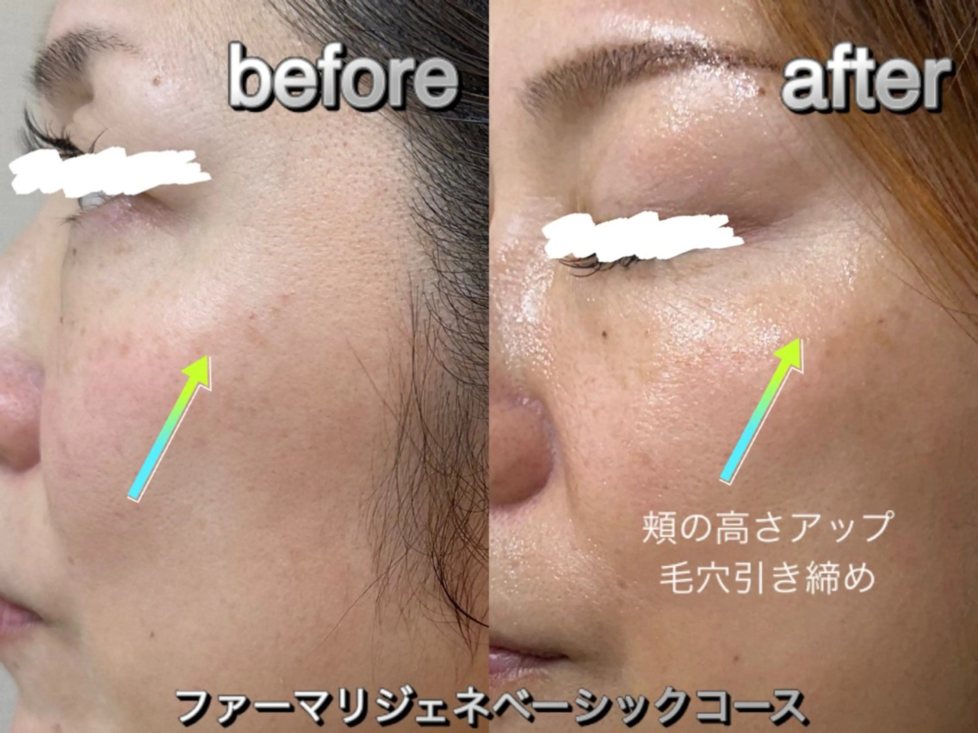 ファーマリジェネベーシック　ビタミンCケアコースの写真