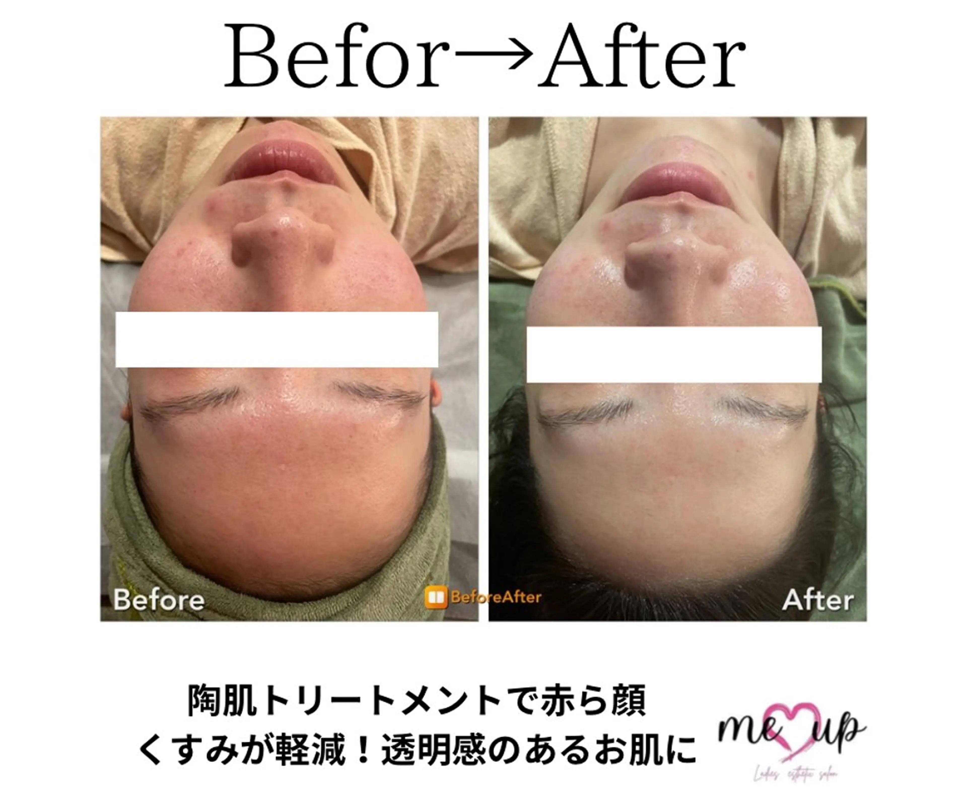 エステ Meupニキビ専門店 背中/ハーブ/ララのその他イメージ