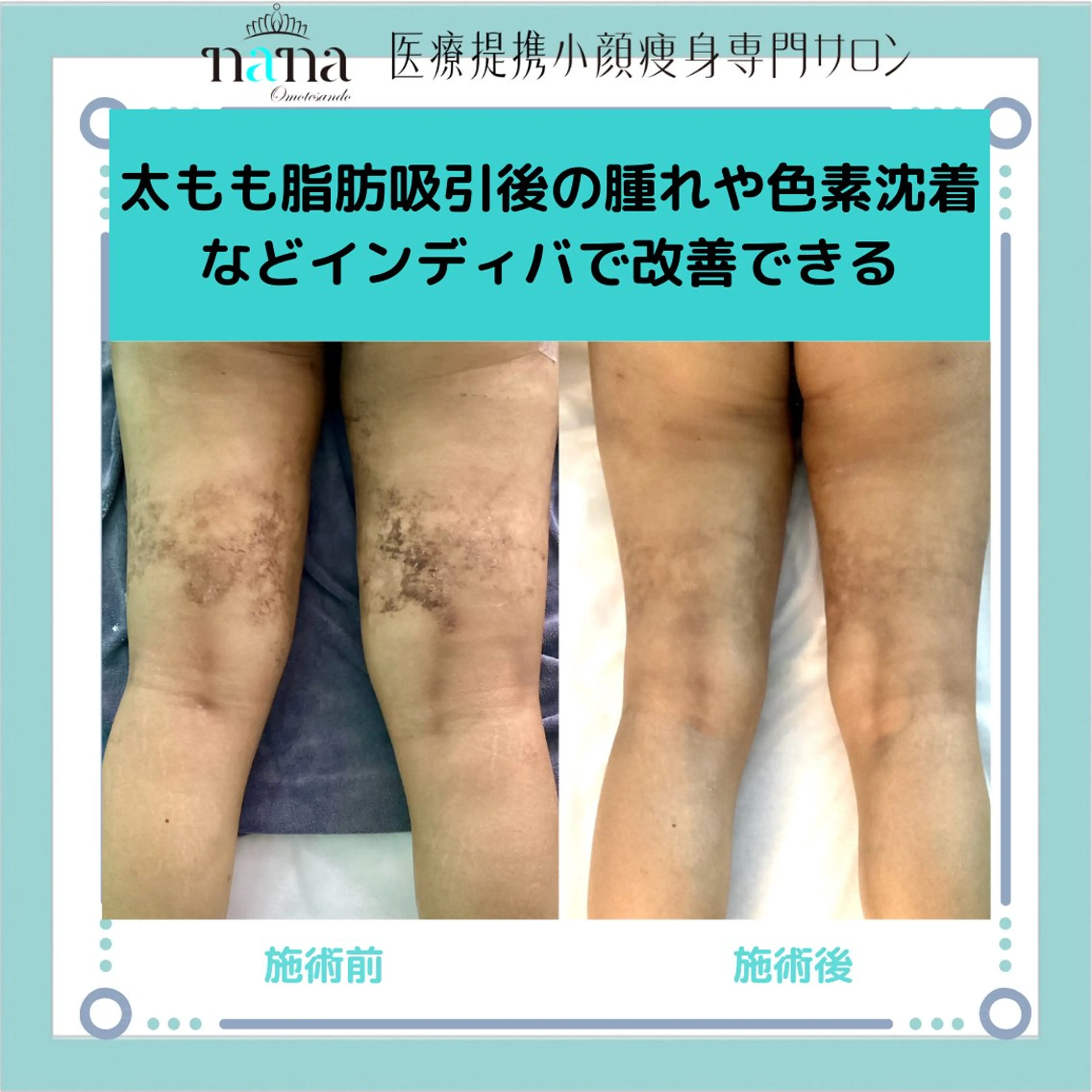 エステ リラク 小顔痩身インディバ Nana表参道のエステ・リラクイメージ