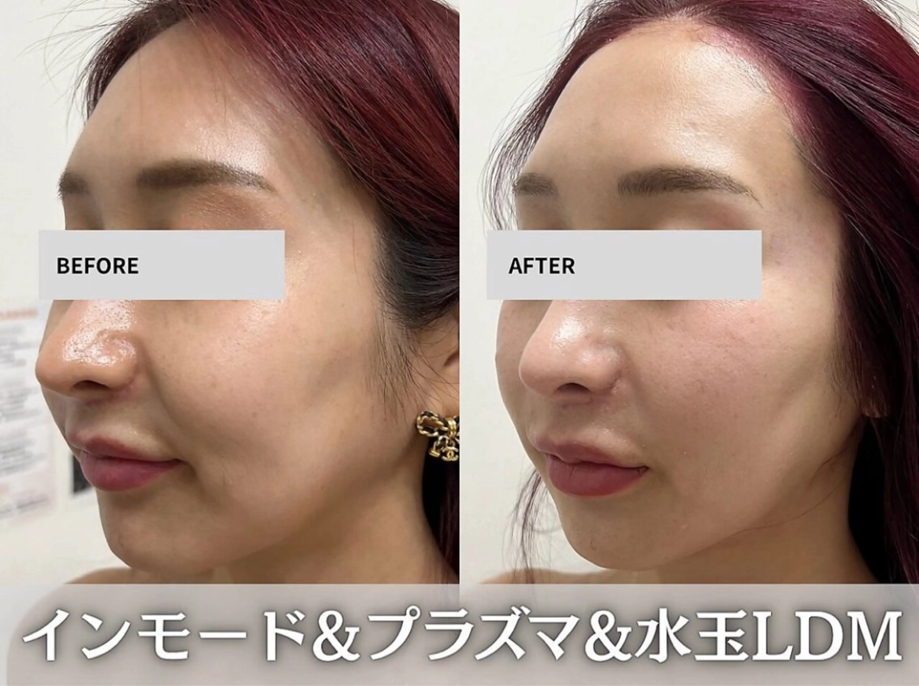 小顔人気Ｎｏ.1インモード×プラズマ×水玉LDM 3点！【お顔の脂肪、二重顎、小顔】の写真