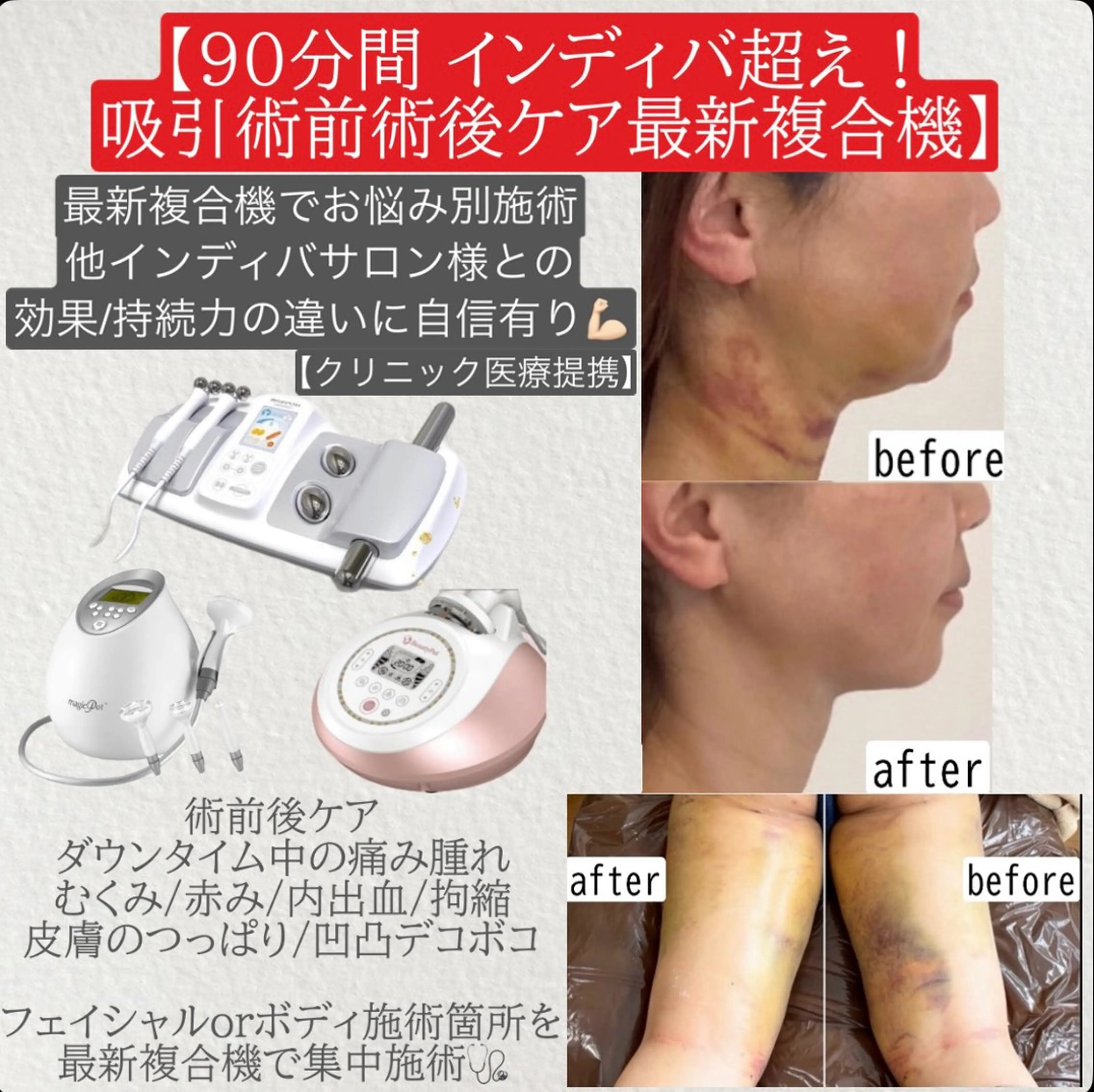 医療提携🩺人気No.1🏆脂肪吸引術前術後ケア🥼最新複合痩身機でインディバ超えの効果に自信アリ💪🏻90分徹底ケアの写真