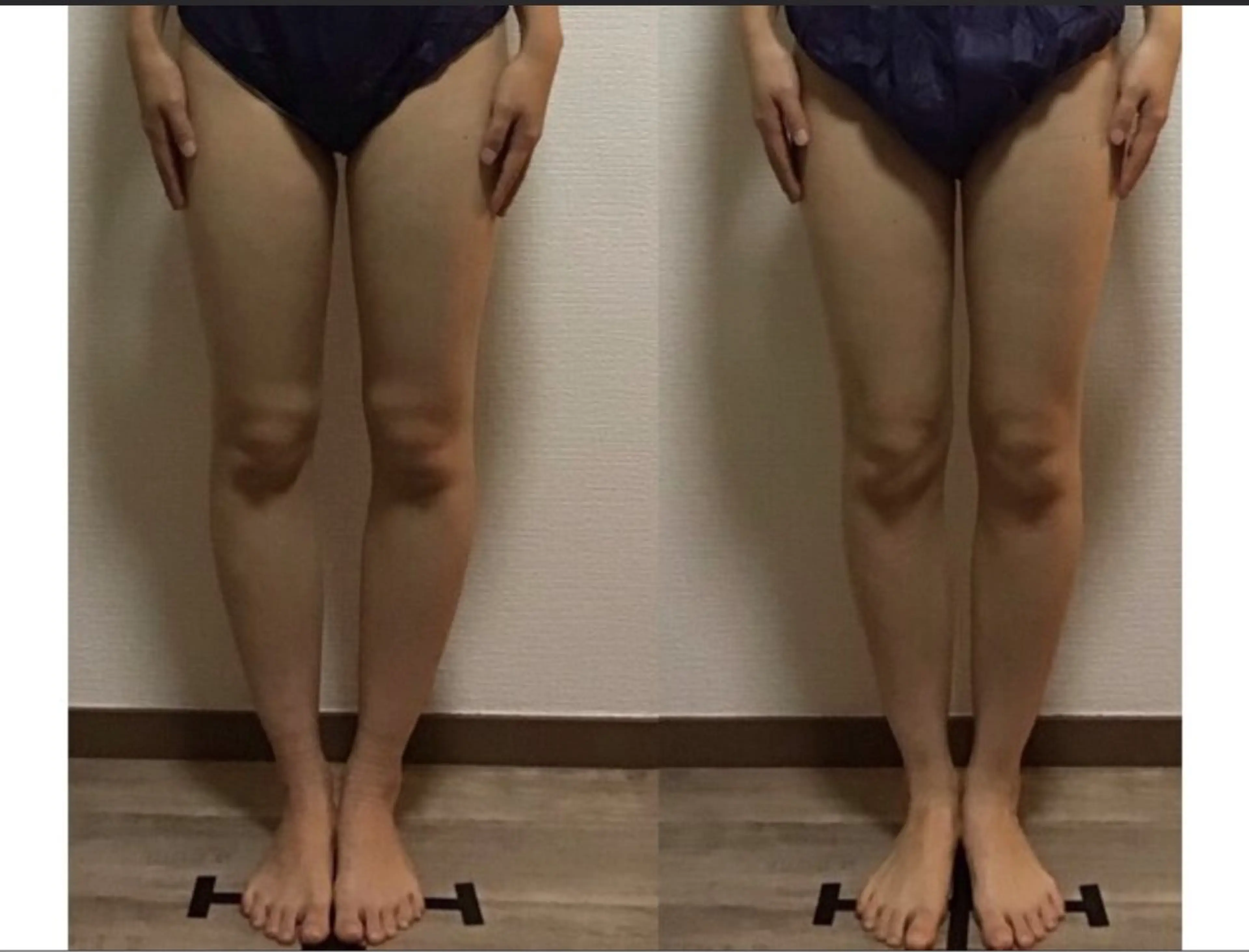 《下半身太りの方必見》ヒップUP•脚長効果•O脚改善も！の写真