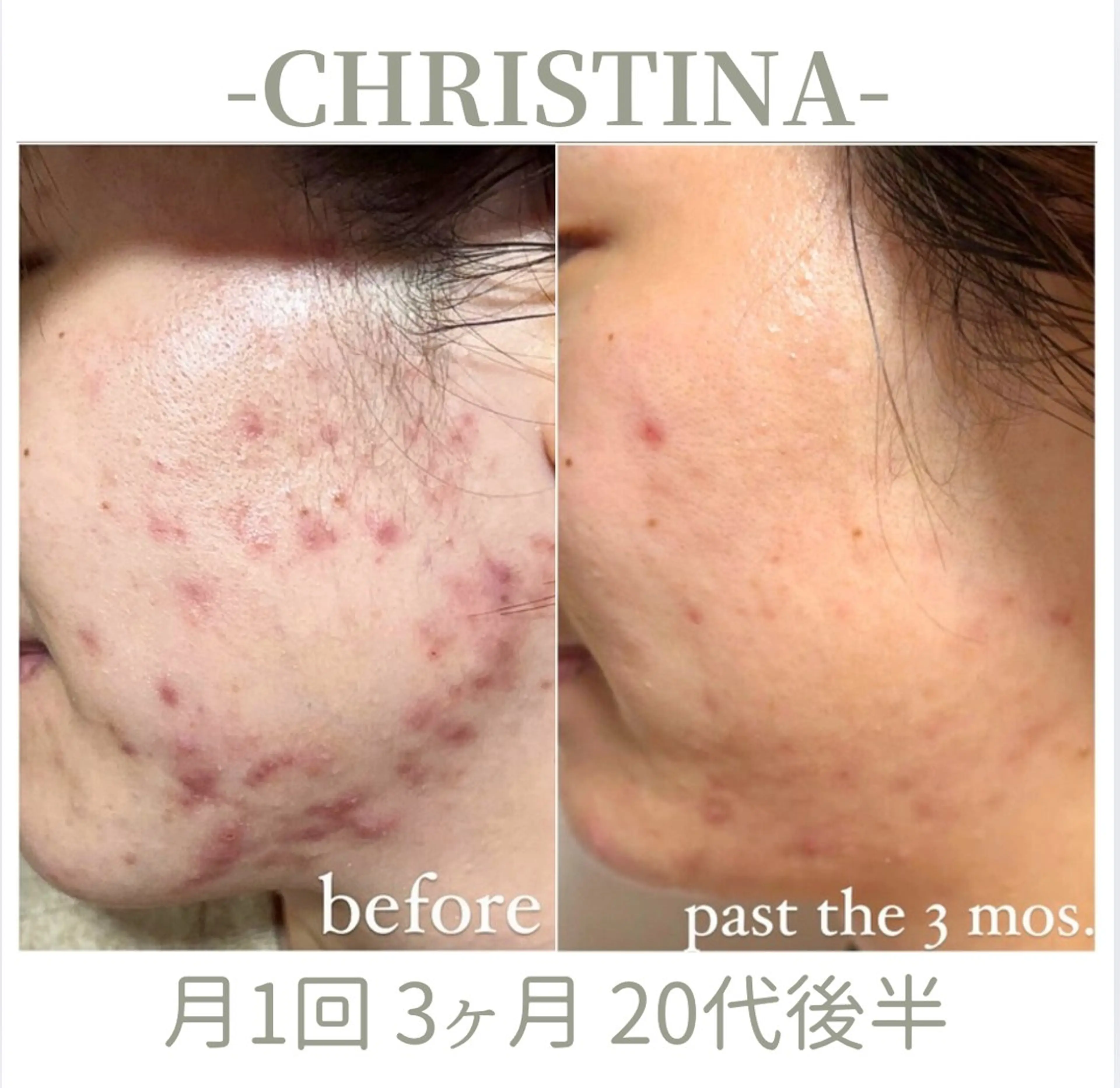 【ニキビ肌専門🧴】大人ニキビ・皮脂・赤みを根本ケア✦コモデックス|クリスティーナ天王寺・大阪💎の写真