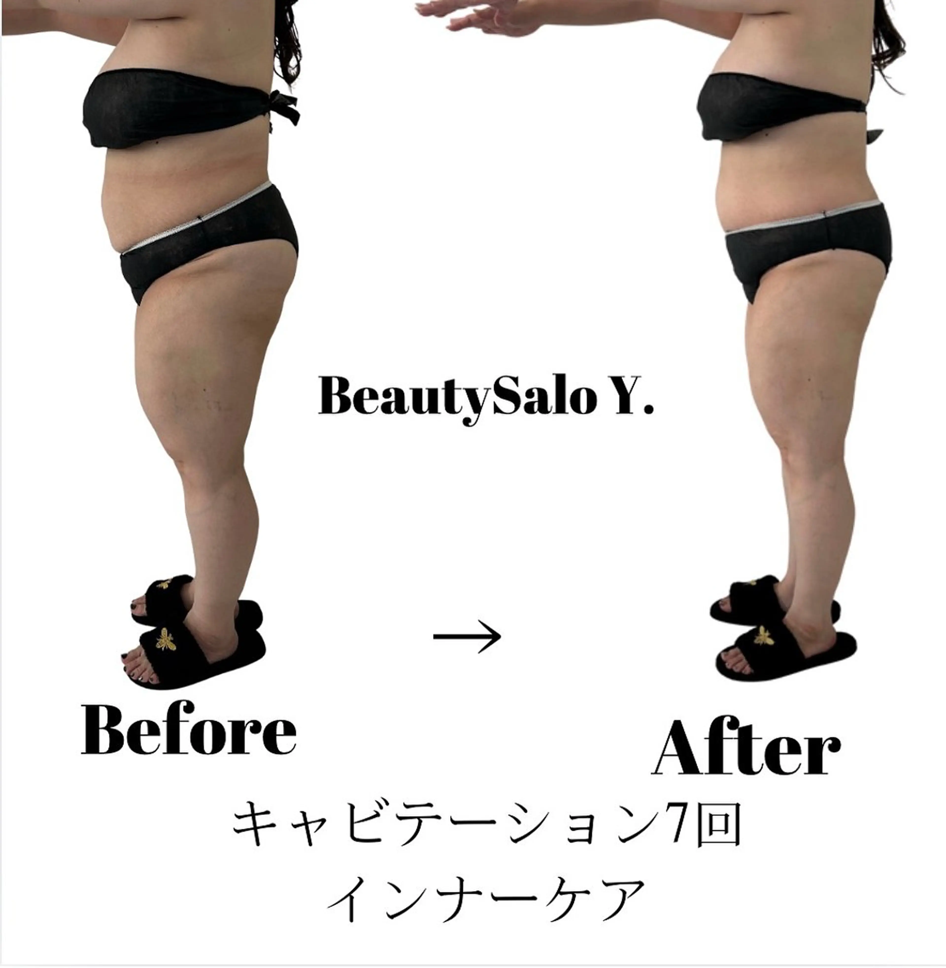 【全身気になる方におすすめ】脂肪を落とすキャビテーション&ダイエットリンパマッサージ90分の写真