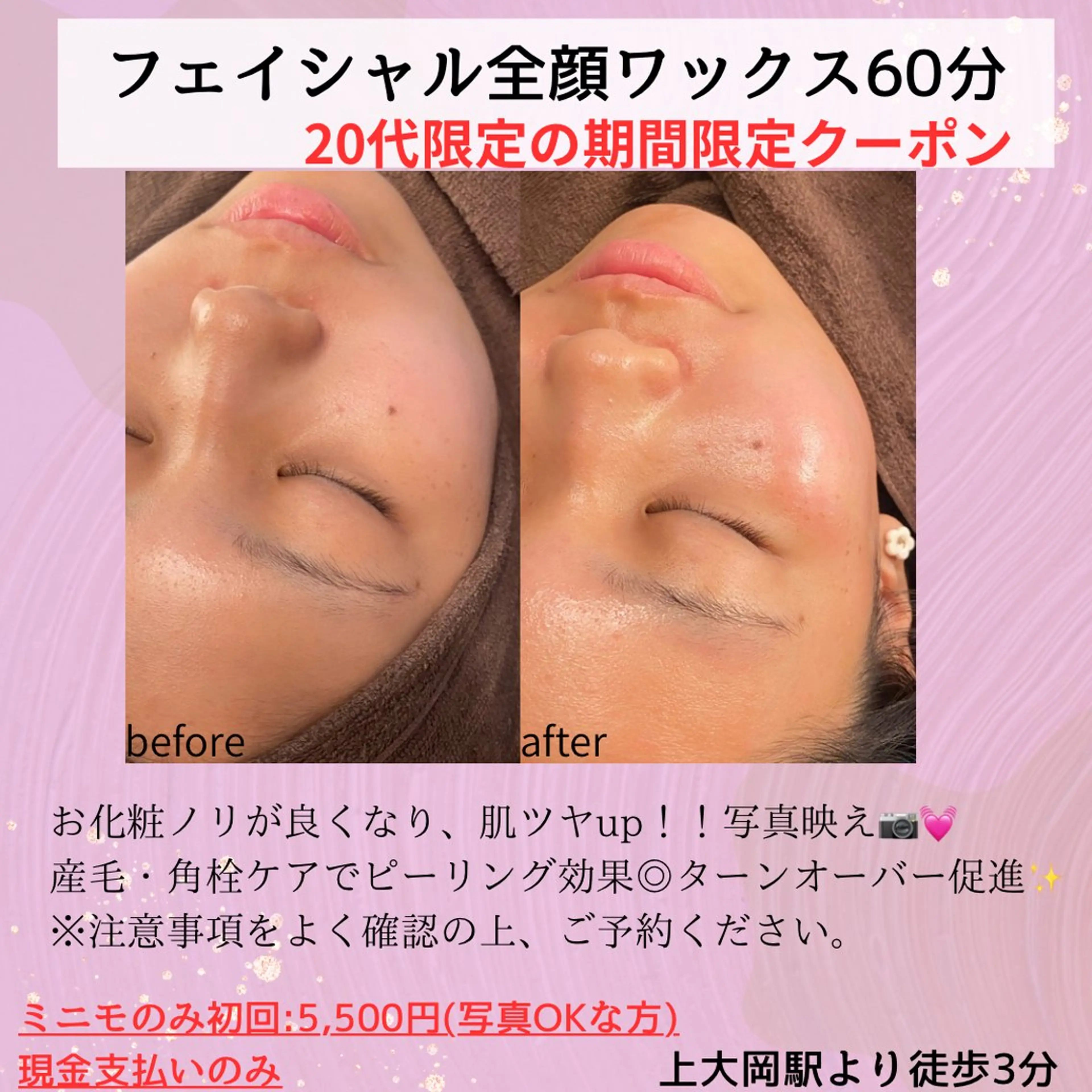 20代女性限定⚠️フェイシャル全顔ワックス✨産毛や角質ケアができピーリング効果◎お化粧ノリ・ツヤupで写真映え💖の写真