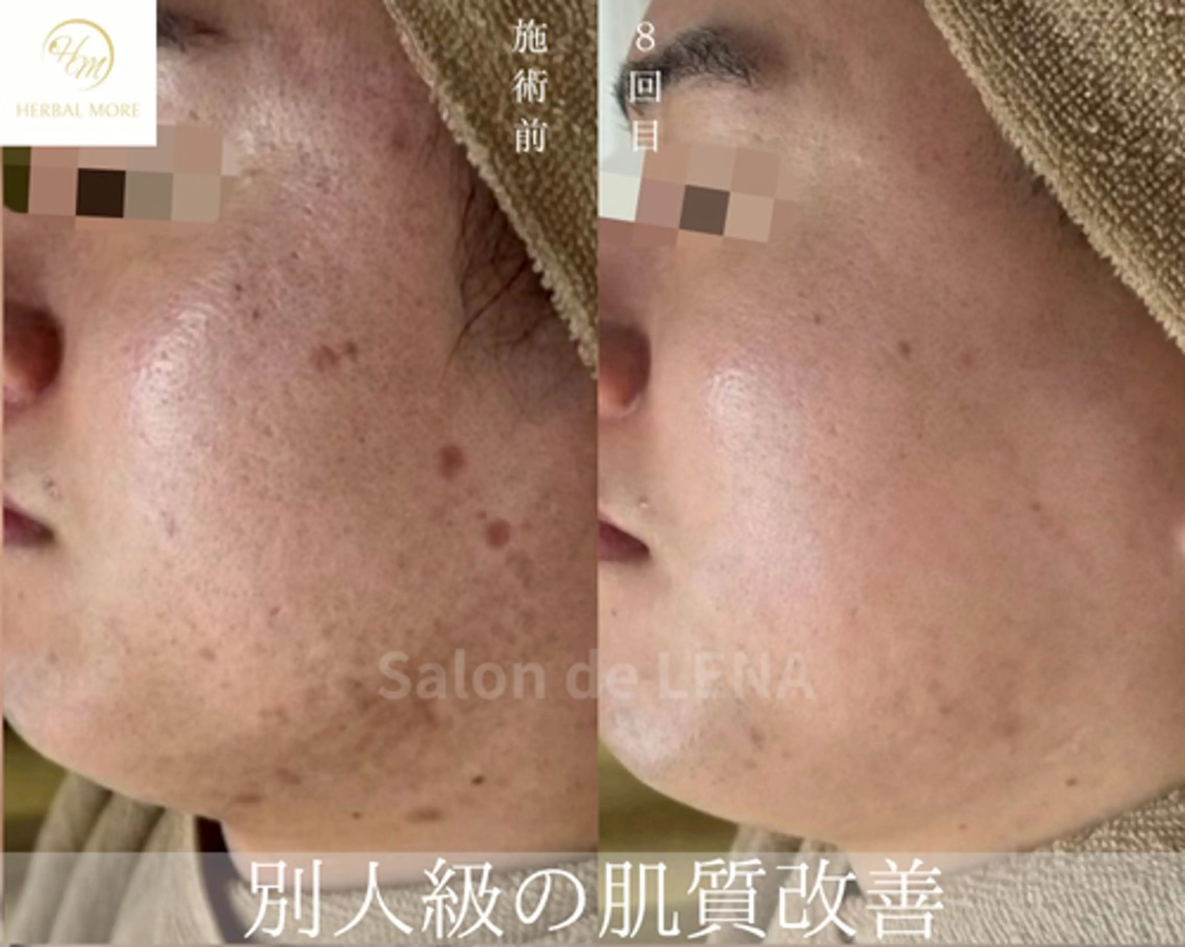 ハーブピーリング・毛穴ケア専門サロンSalon de LENA 栄店所属・ハーブピーリング専門 サロンドレナ　白藤のエステ・リラクイメージ