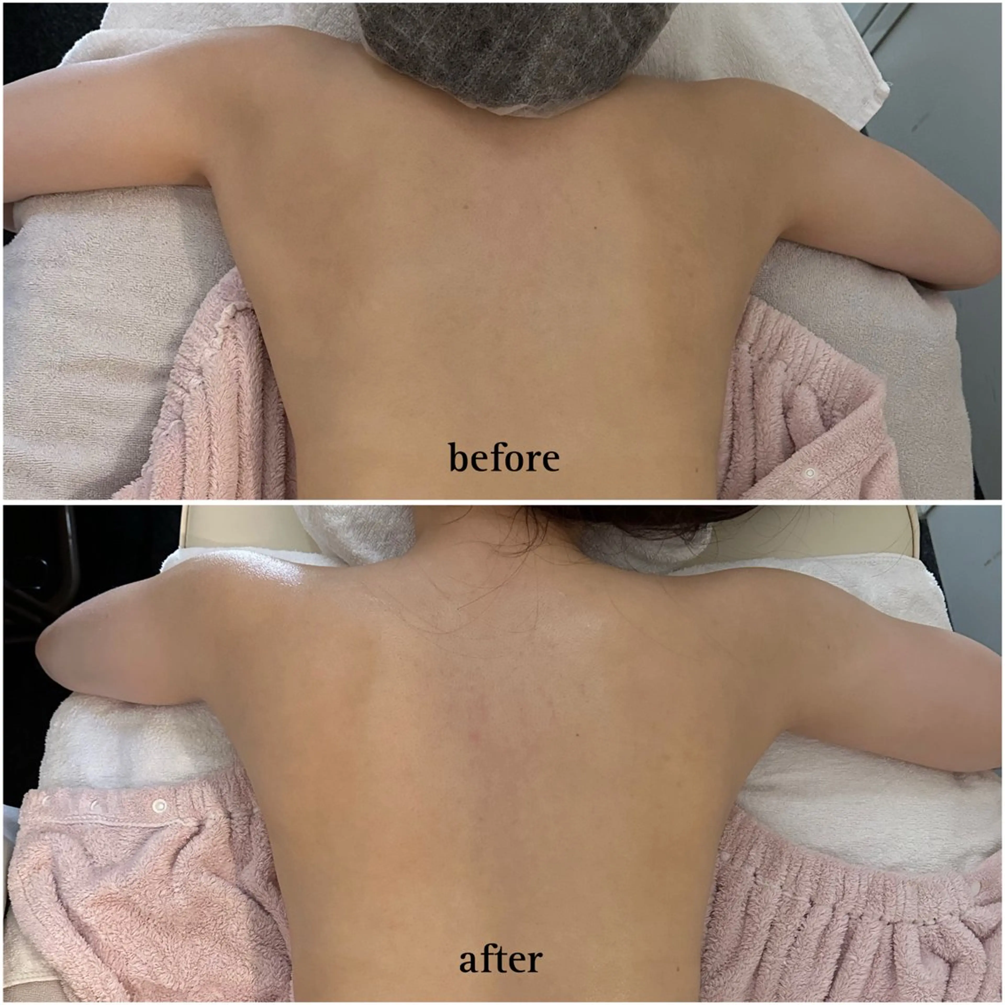 背面エステ⌇肩こり・首こり・腰痛・二の腕ケア⌇姿勢改善🤍の写真