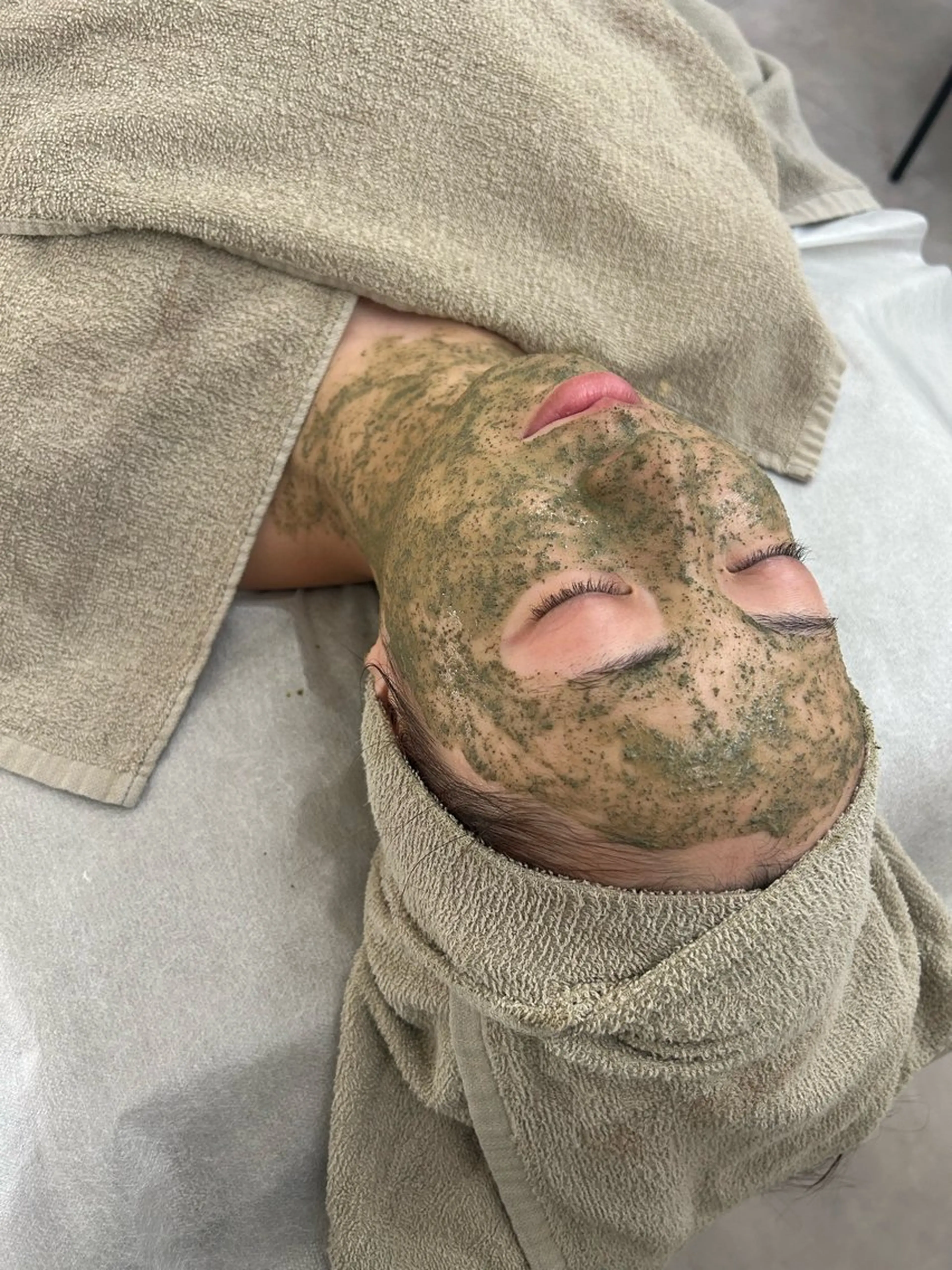 【平日限定⭐️ニキビケアでお悩みの方のみ】REVIハーブピーリングの写真