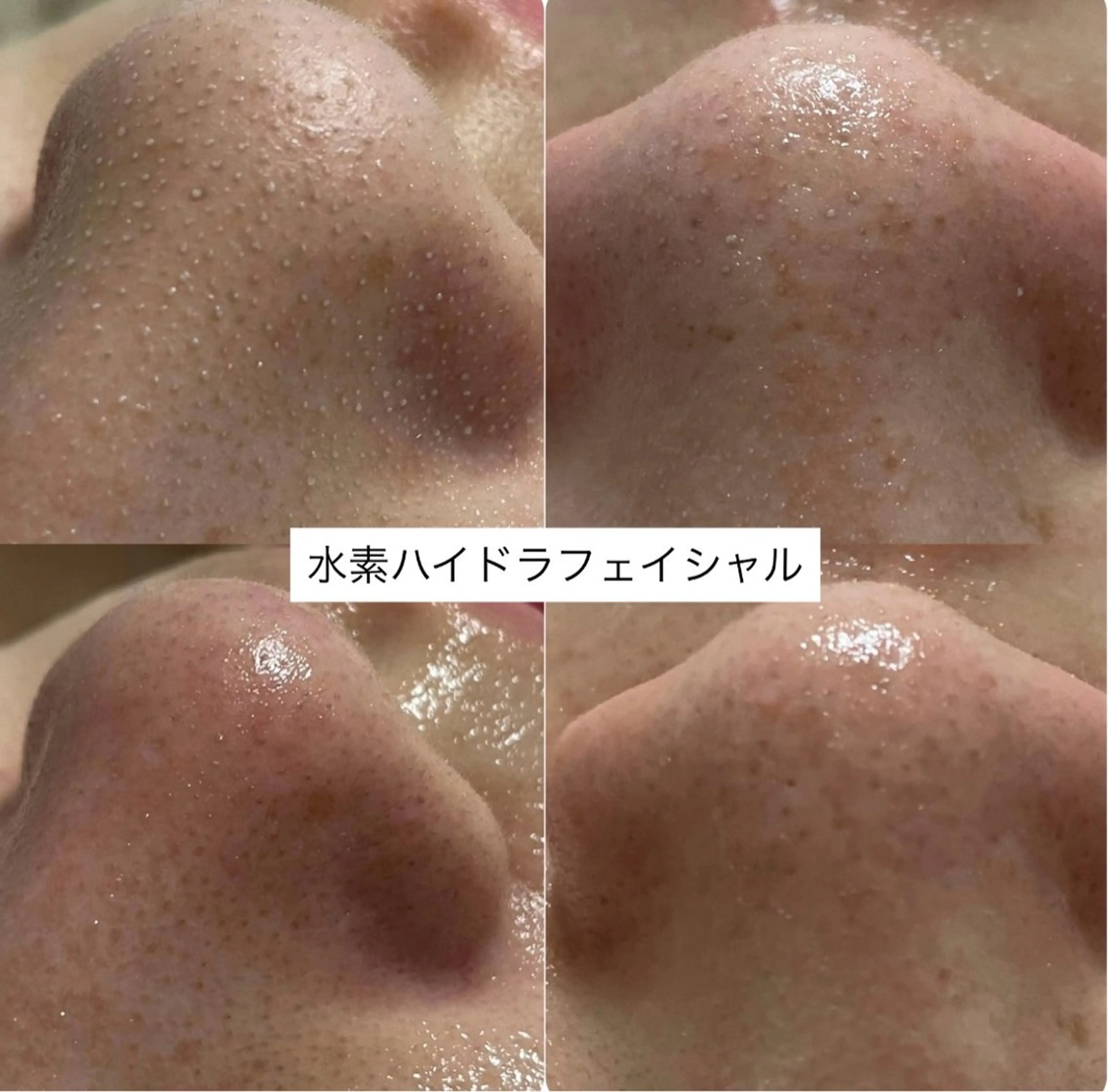 【学生限定クーポン✨❤️】水素ハイドラフェイシャルフルコース🫶🏻✨の写真