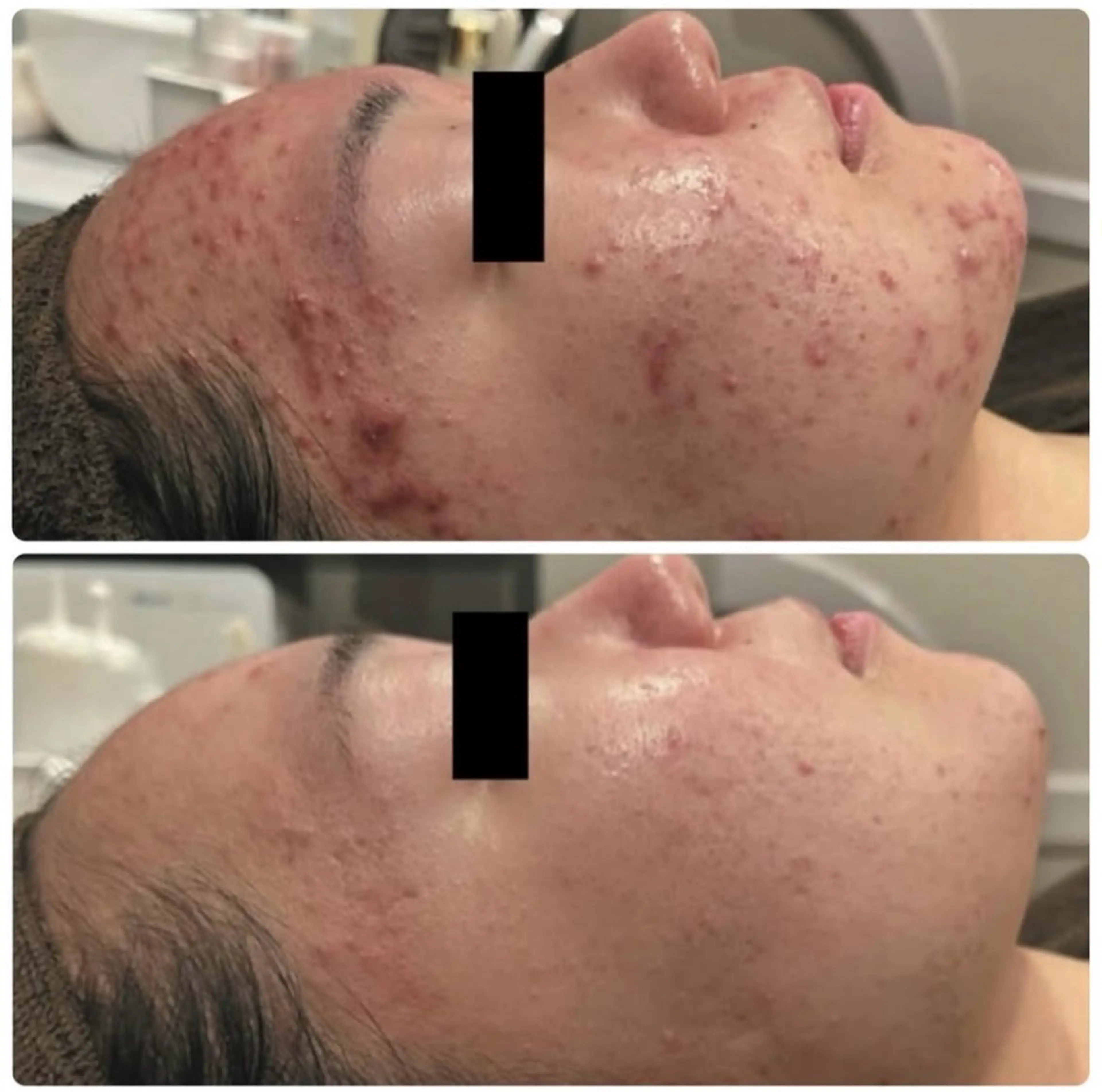 NEW【ホワイトスノーピール】ニキビ肌荒れ改善!ふっくら美肌へ¥13500→¥7500の写真