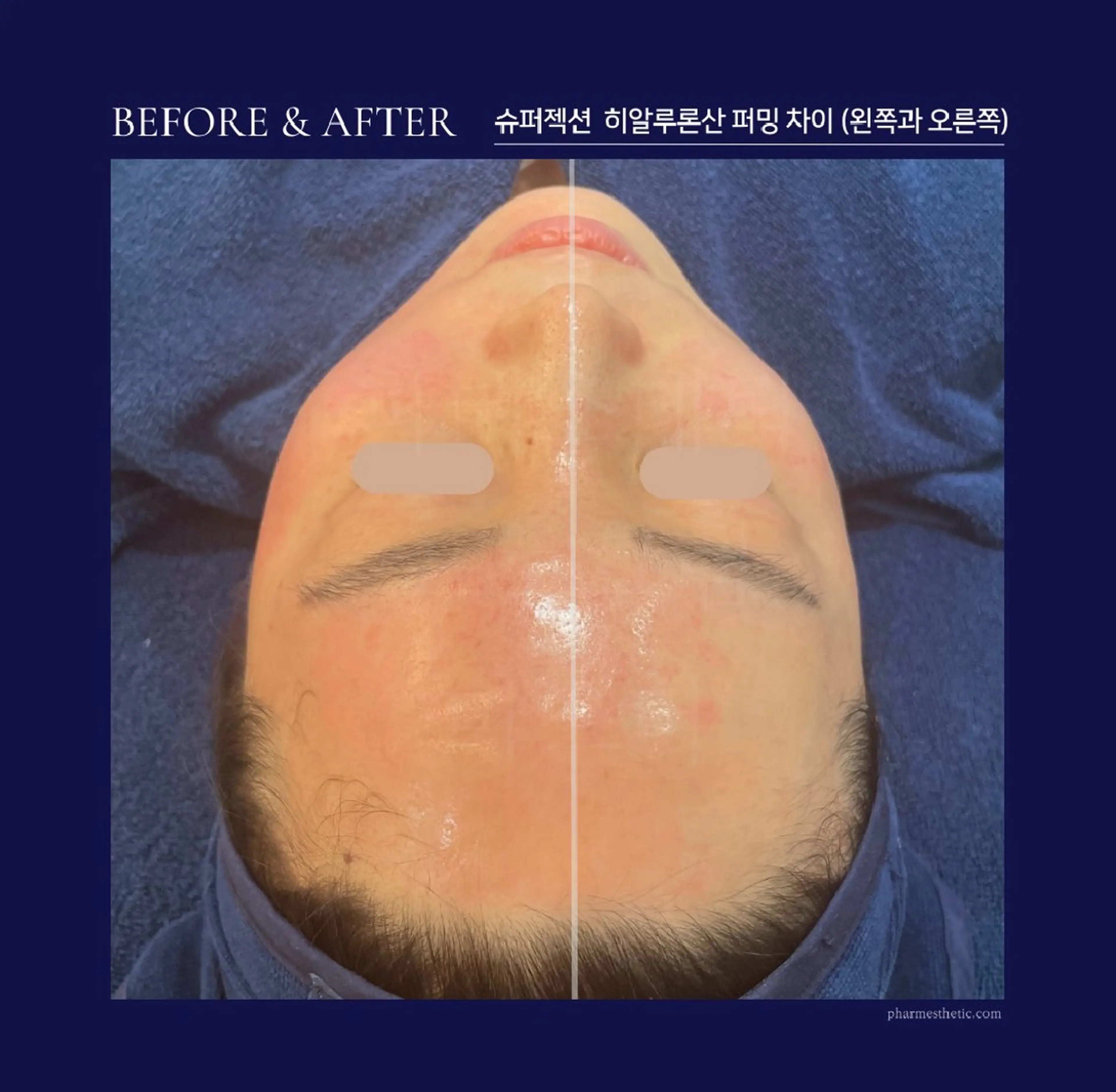 【シワ毛穴】最高級✨スーパージェクション肌質改善フェイシャル（ナノチップ導入）の写真