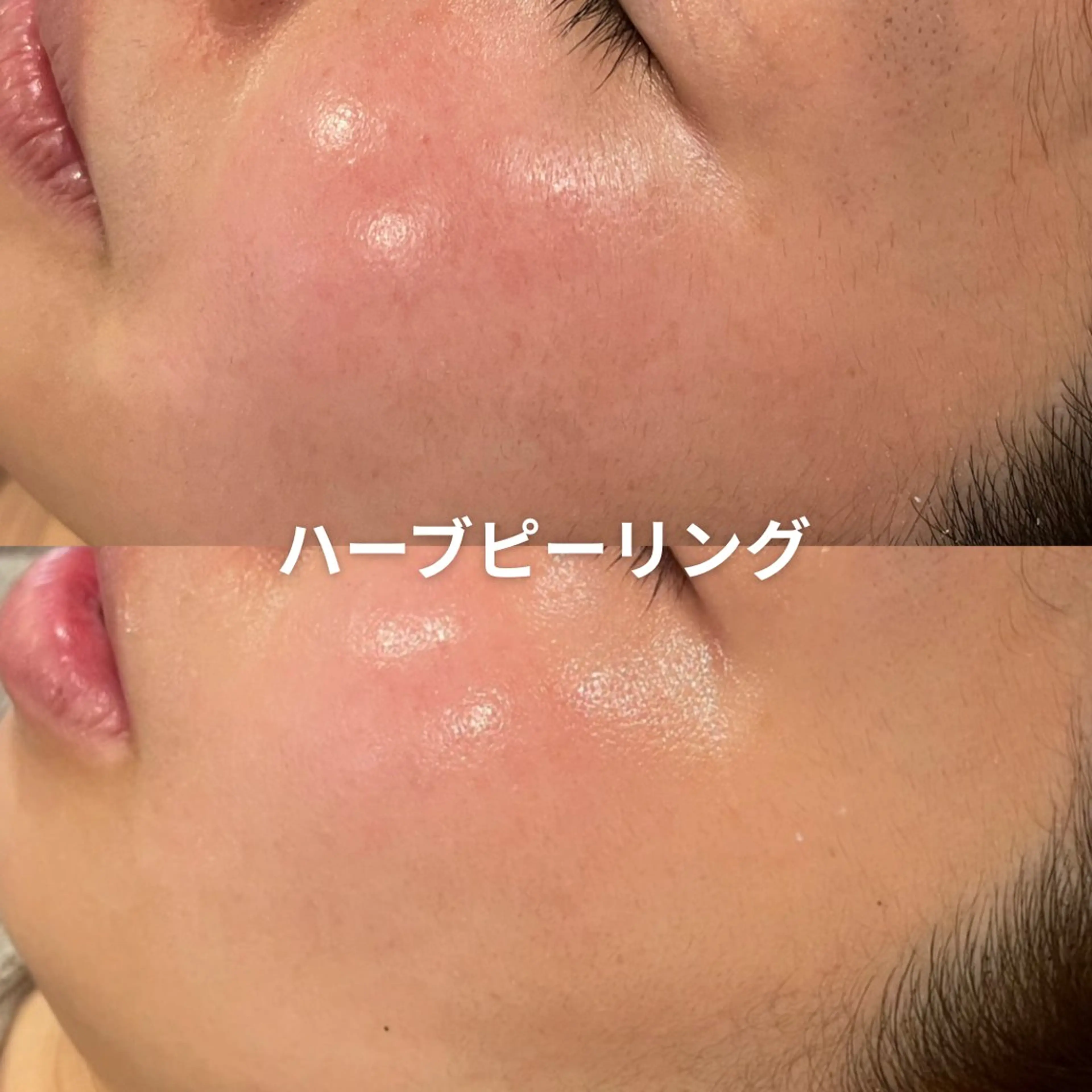 エステ EST BEAUTY所属・顔専門ワックス脱毛/ ハーブピーリングのエステ・リラクイメージ