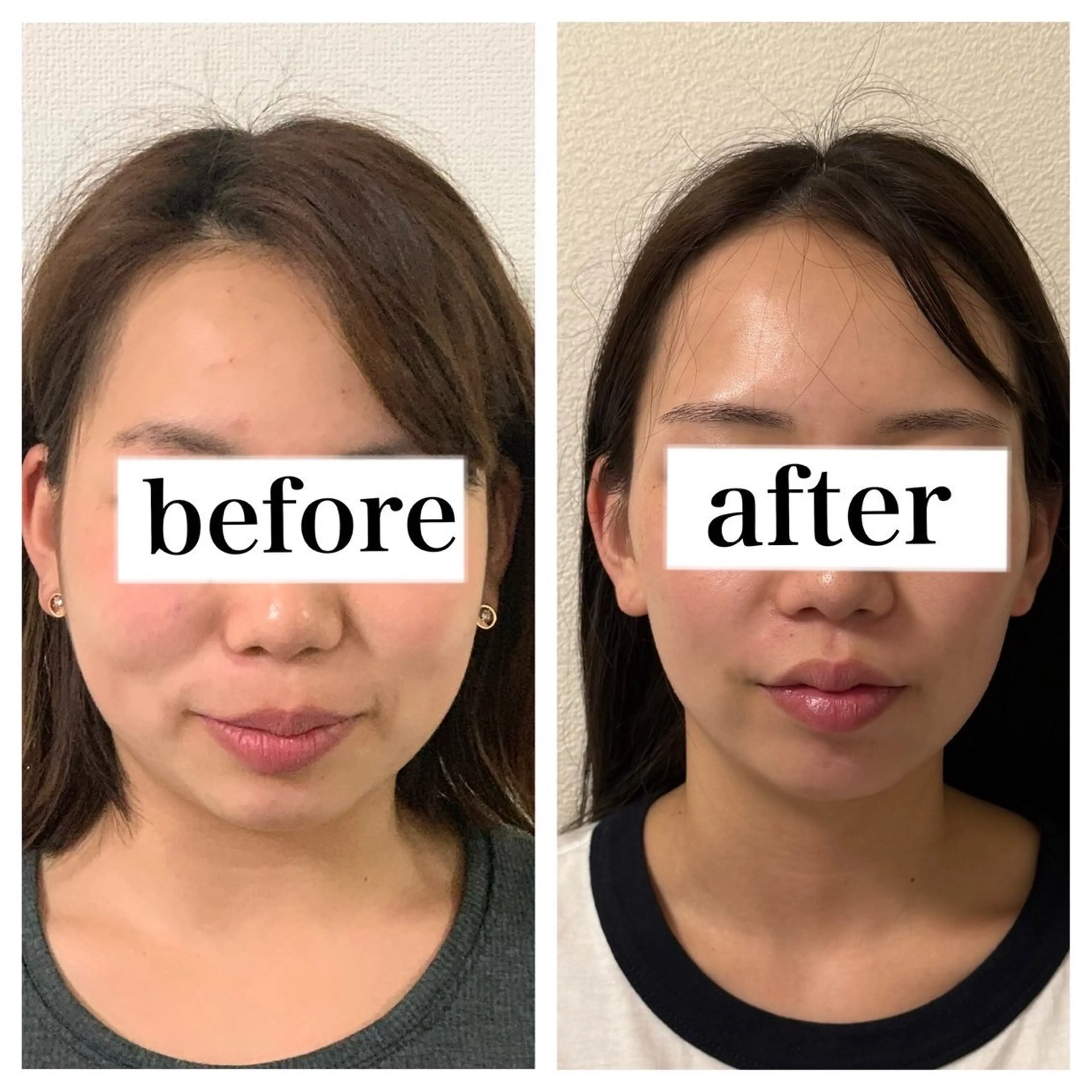 【1番人気最先端はいふ💆‍♀️】1度で小顔！フェイスラインアップ！小顔矯正💆‍♀️×840ショット🔥の写真