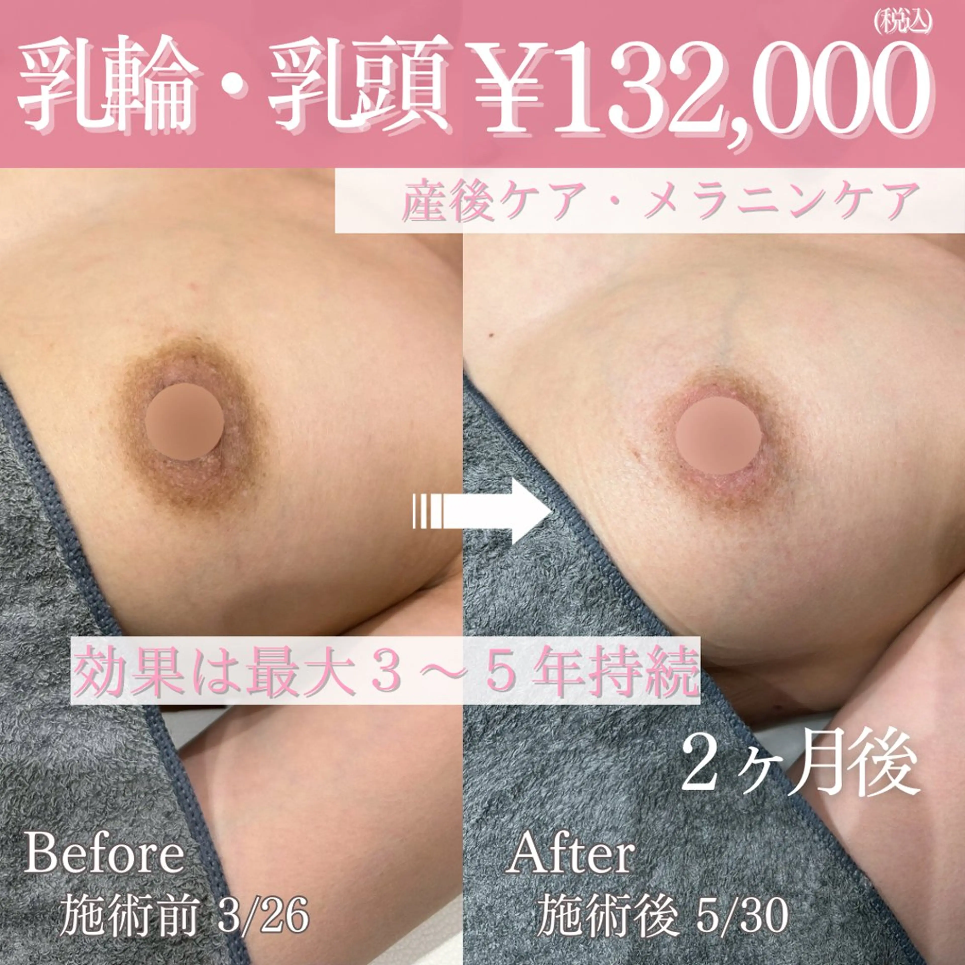 色素沈着・メラニン除去🫧ローマピンク【バスト】の写真