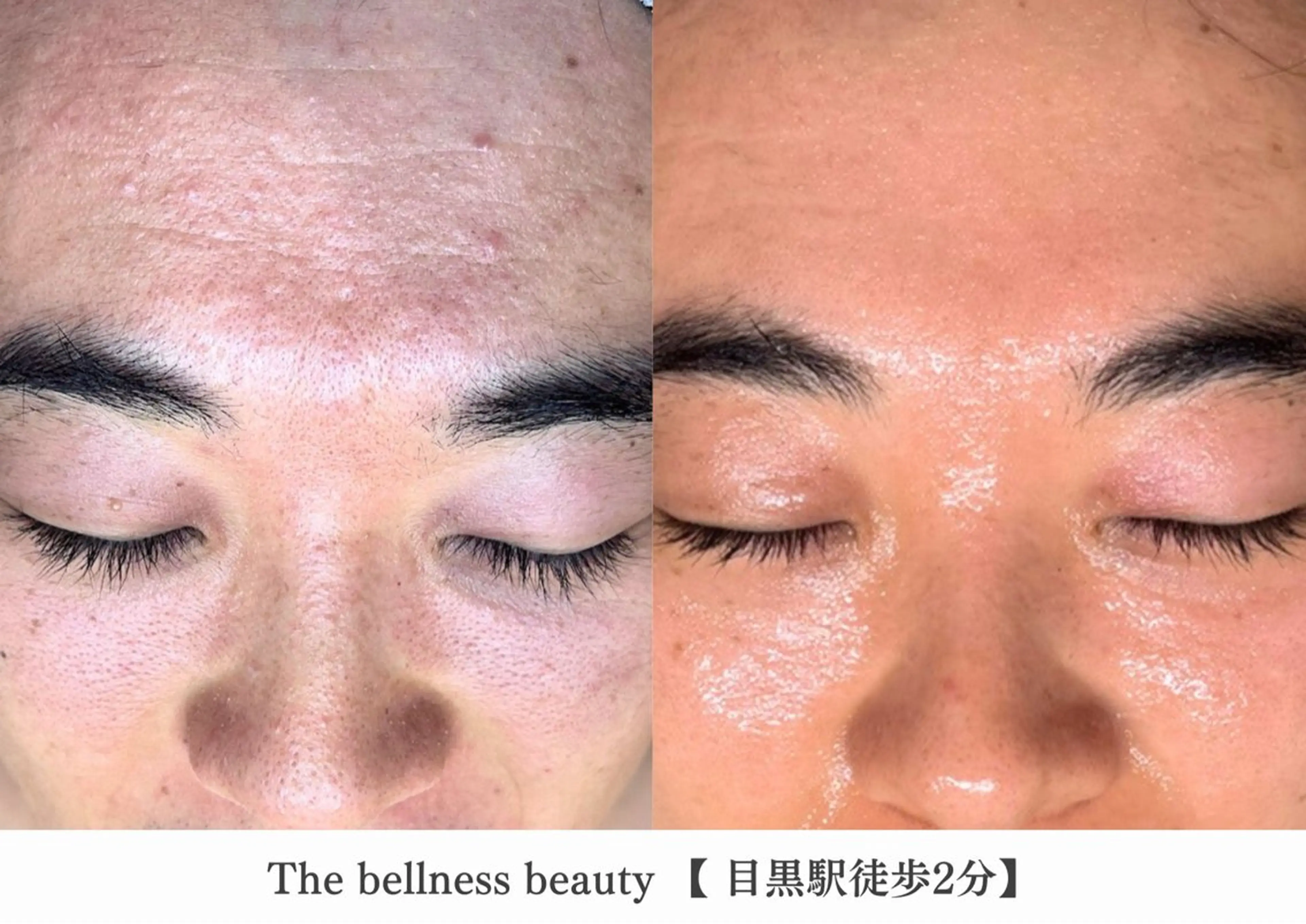 エステ 《毛穴レス美肌》ザ・ ベルネス 目黒駅2分のエステ・リラクイメージ