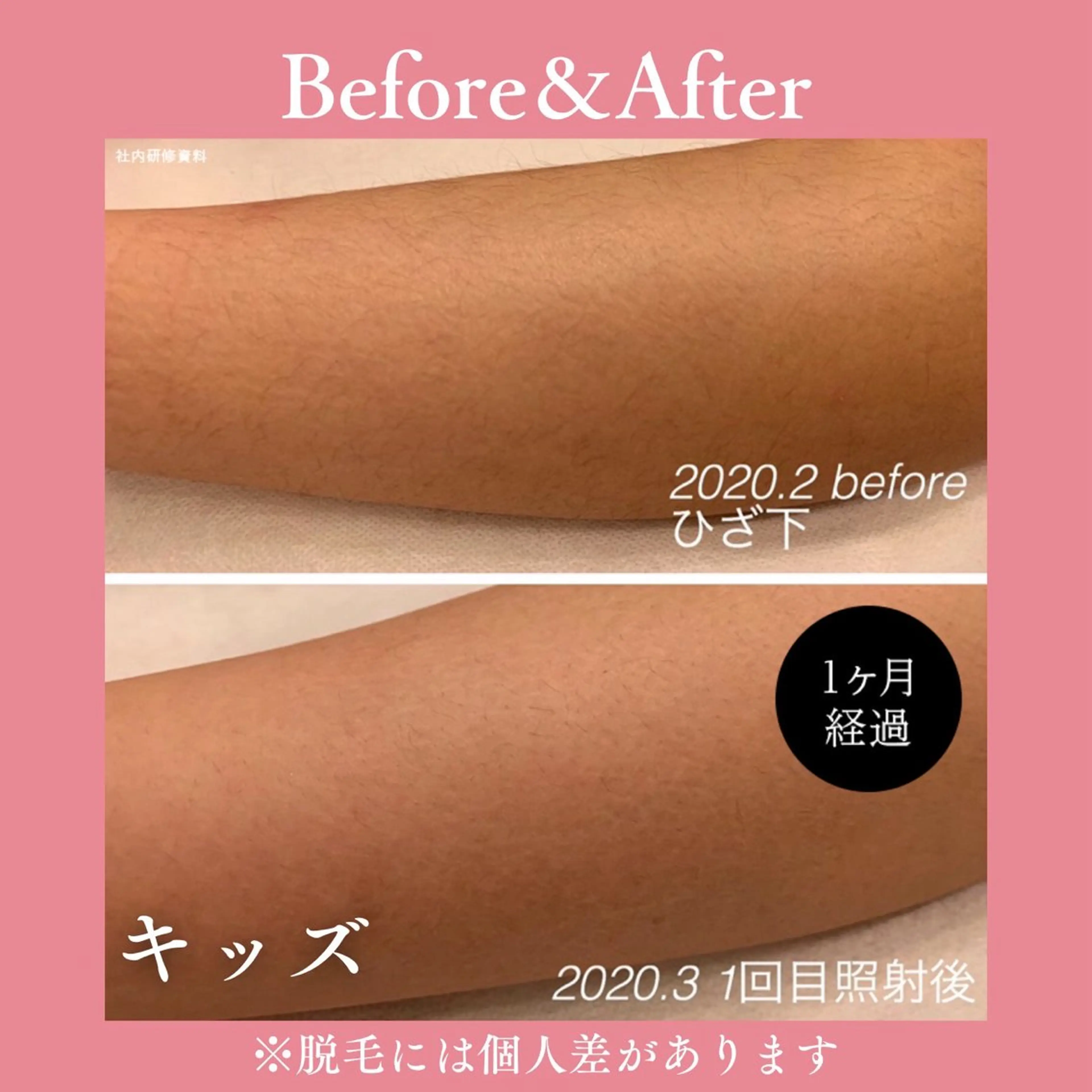 メンズ キッズ 有人型セルフサロン 脱毛/痩身/美顔のその他イメージ