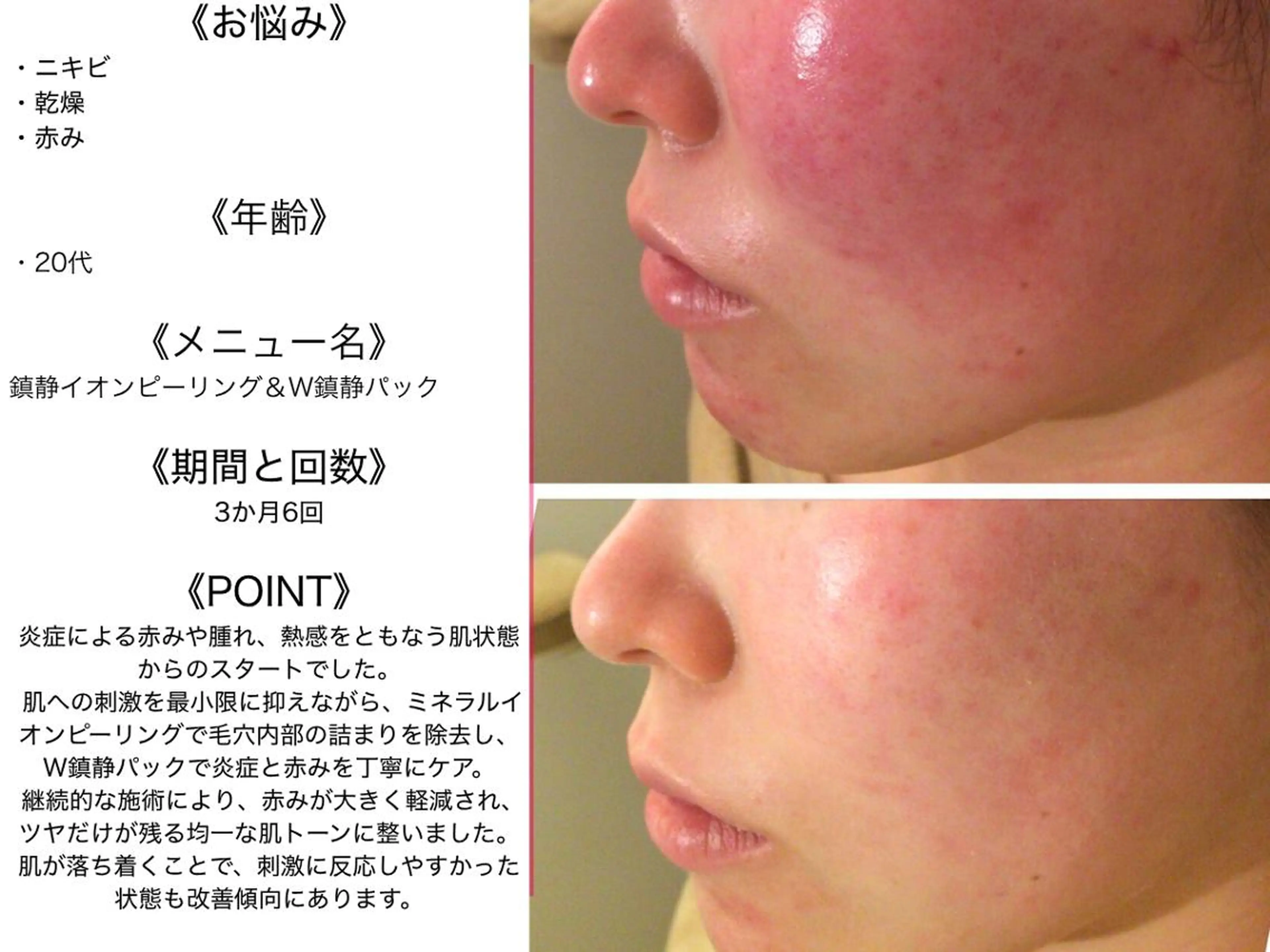 エステ リラク 皮膚科より効果あり ⁉️最短ニキビ改善のエステ・リラクイメージ