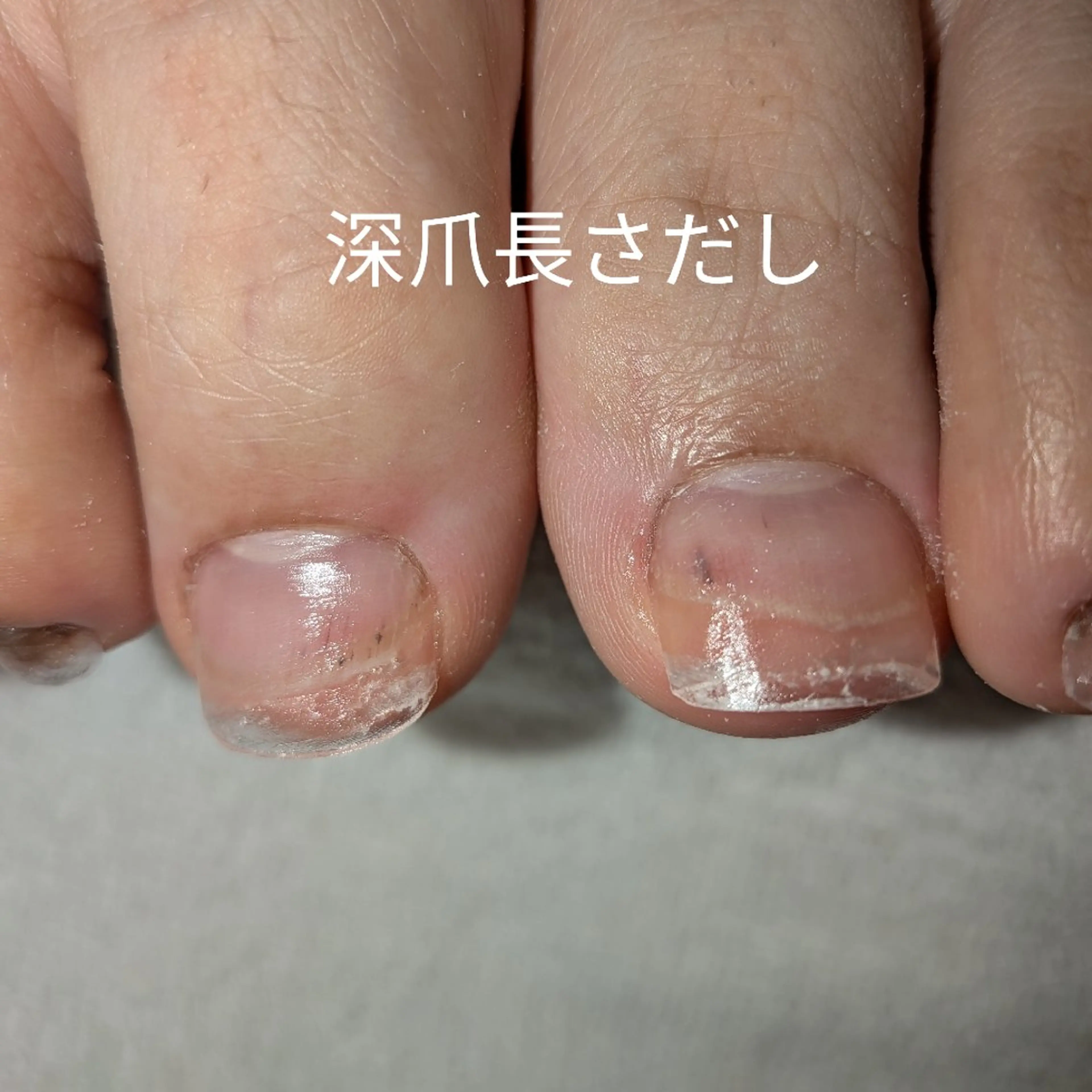 ネイル フットネイル ネイリストゆか💅 長さだし、深爪矯正のネイルデザイン
