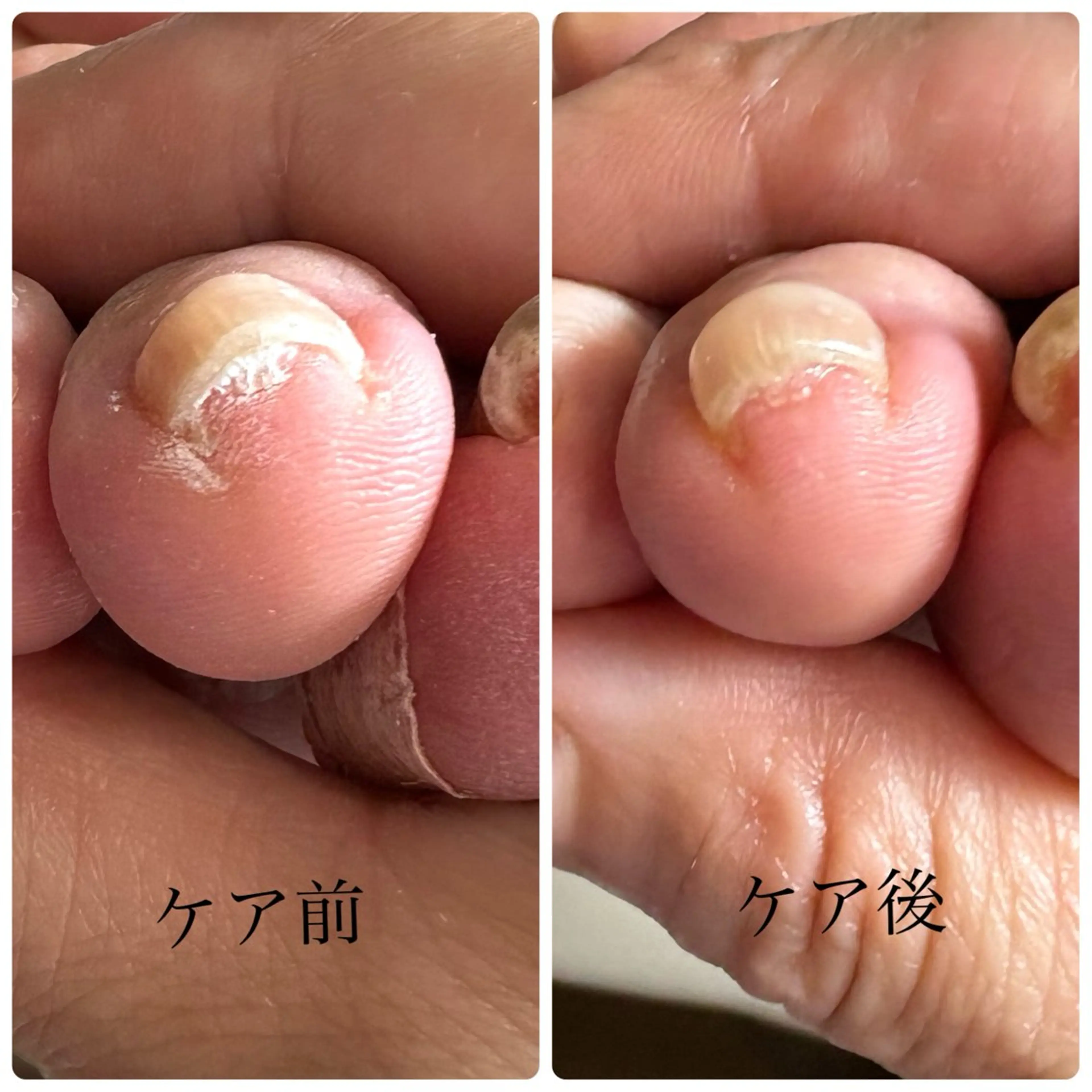 巻き爪ケア親指以外の写真