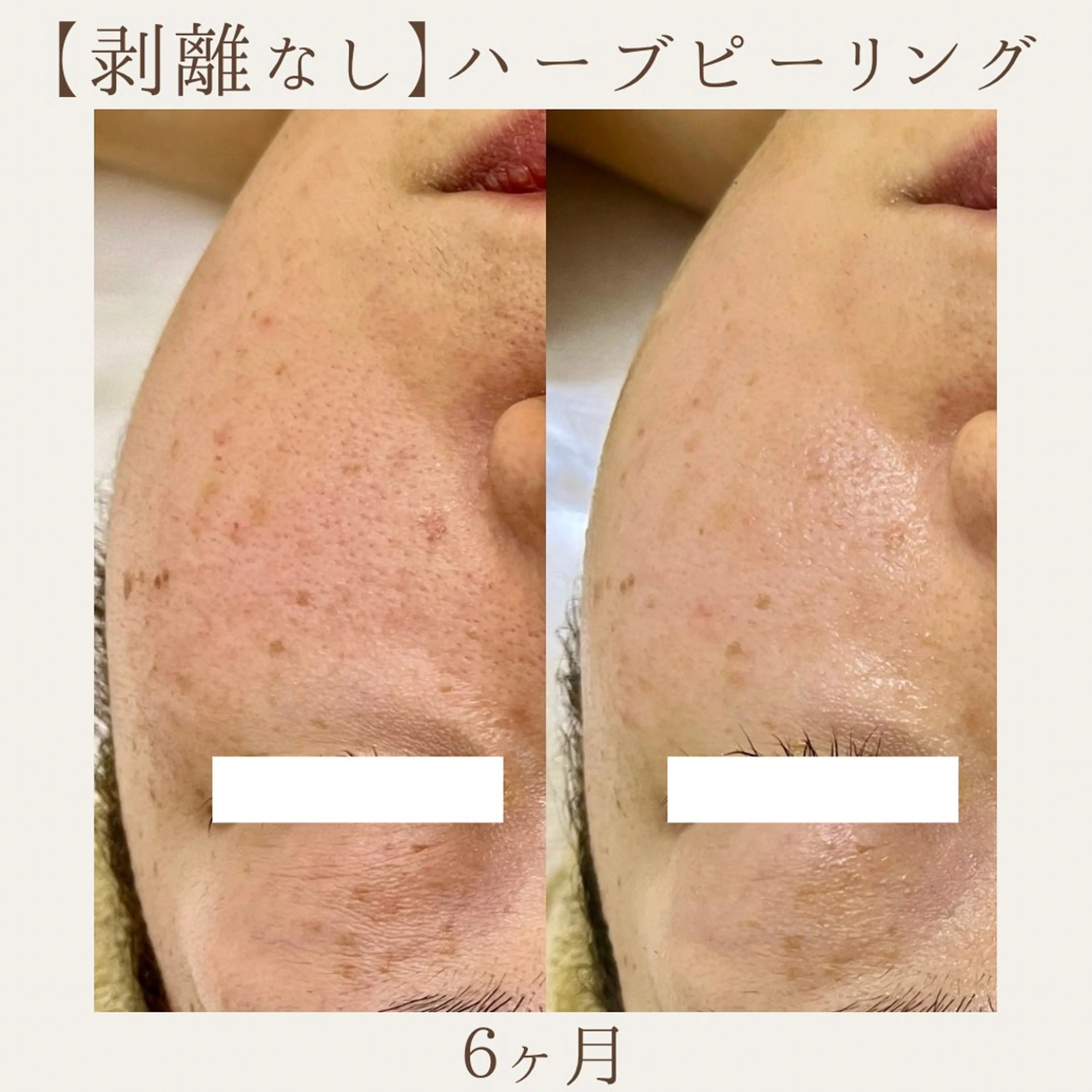 エステ 肌質改善サロン renew所属・肌質改善サロン renew/ｳｴｷのエステ・リラクイメージ