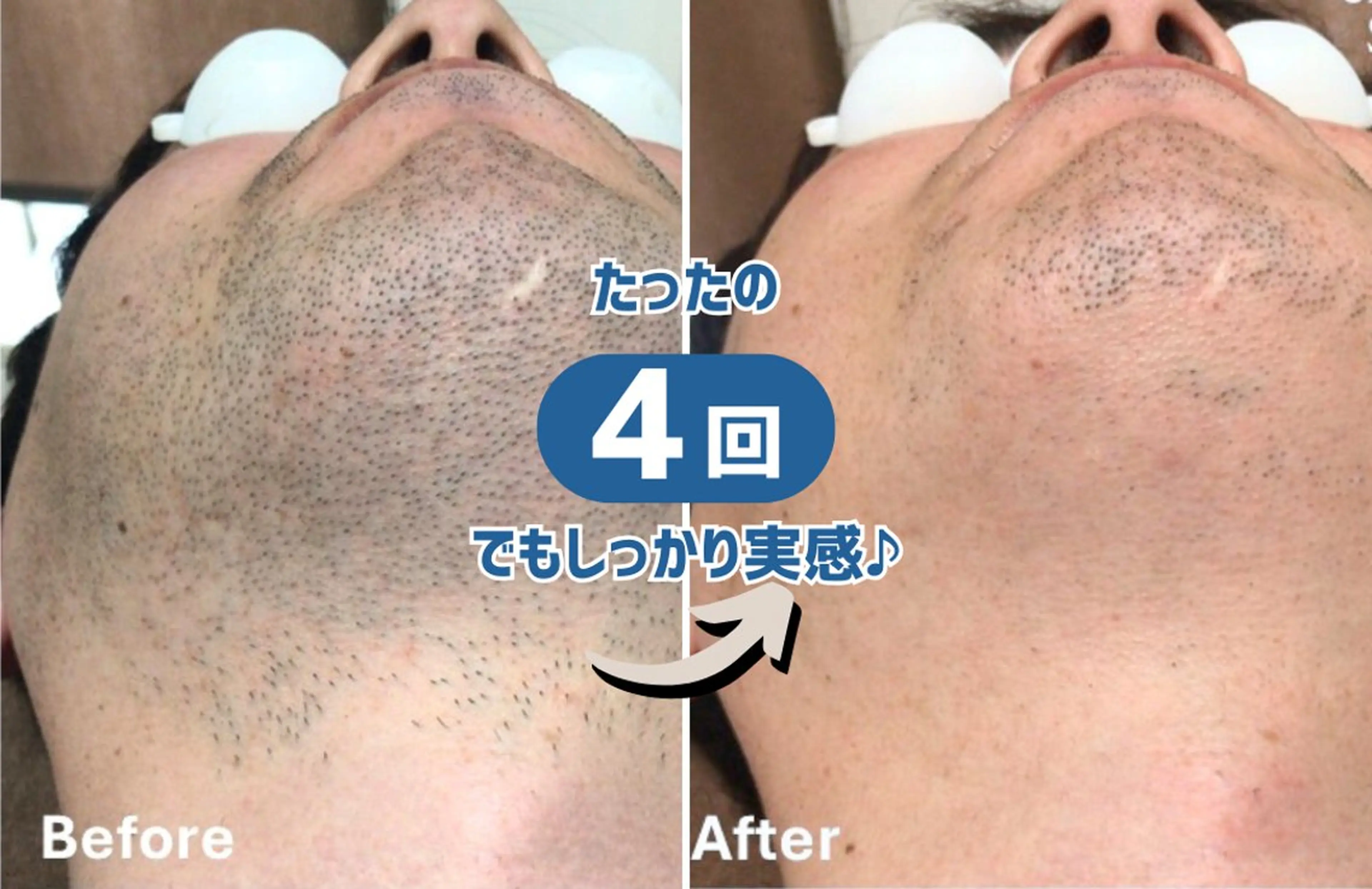 脱毛サロン　チル半田店所属・脱毛・毛穴洗浄 チルのエステ・リラクイメージ