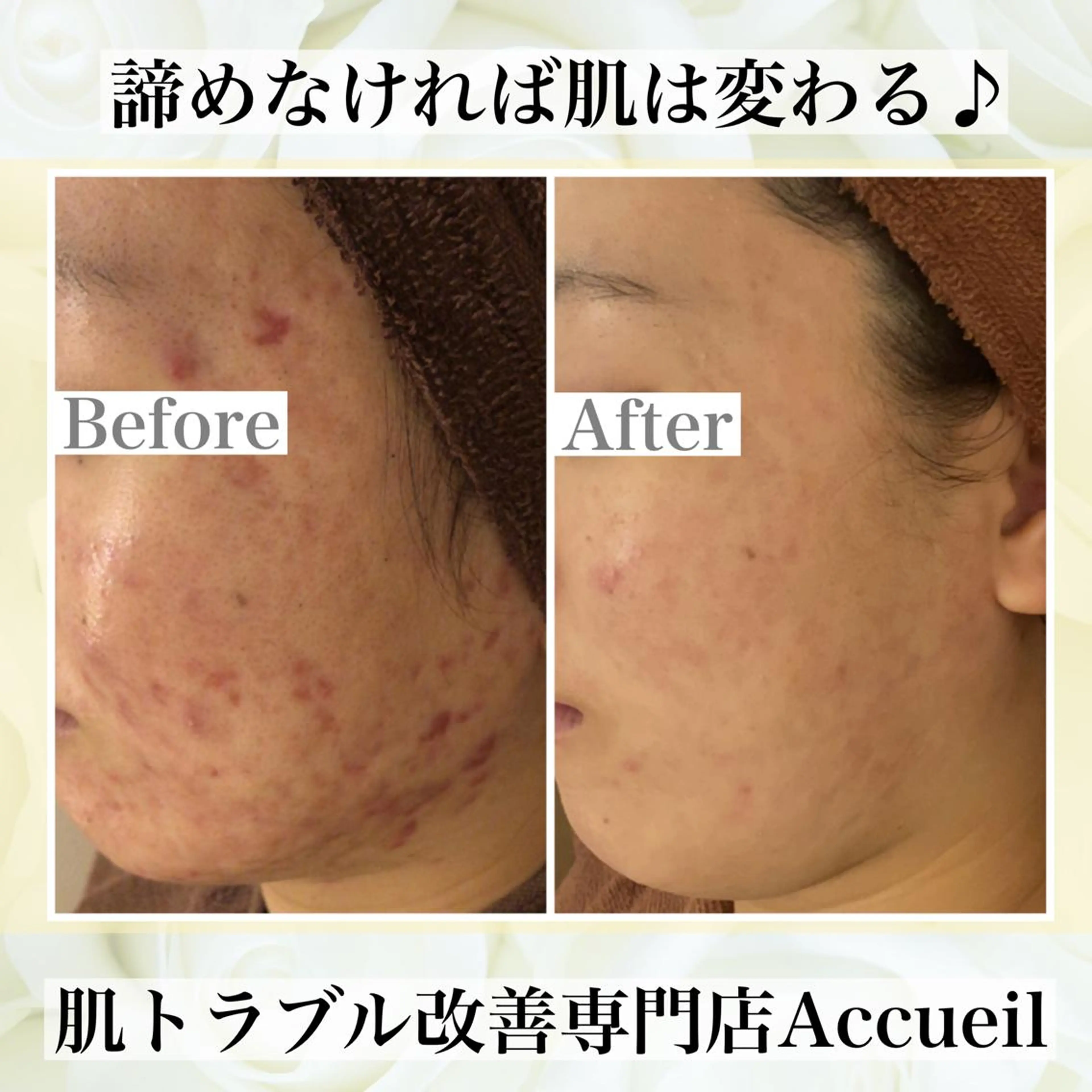 皮膚科より効果あり ⁉️最短ニキビ改善のエステ・リラクイメージ