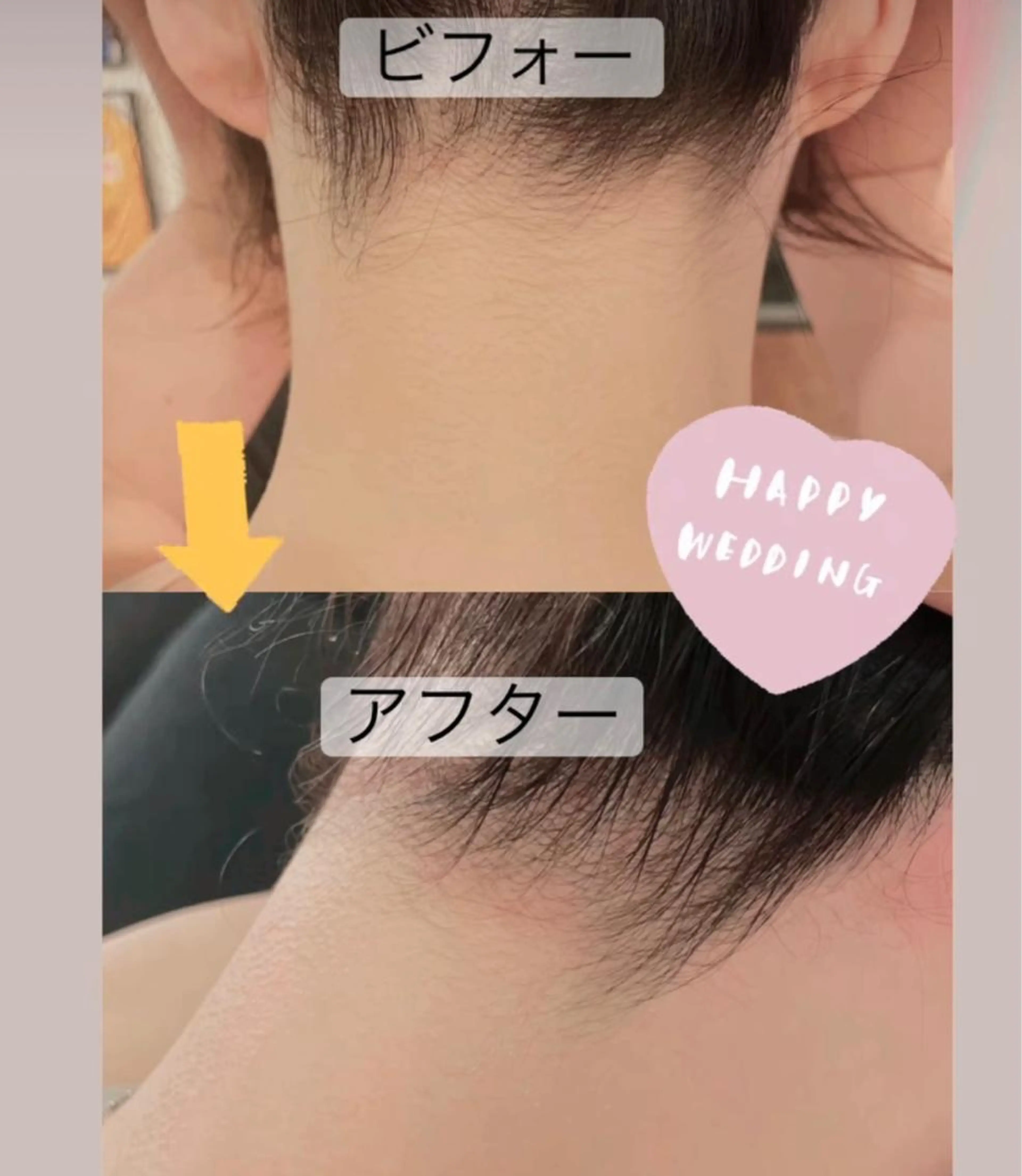 うなじ&お鼻🦋✨鎮静パックはサービス❤︎ 🦋の写真