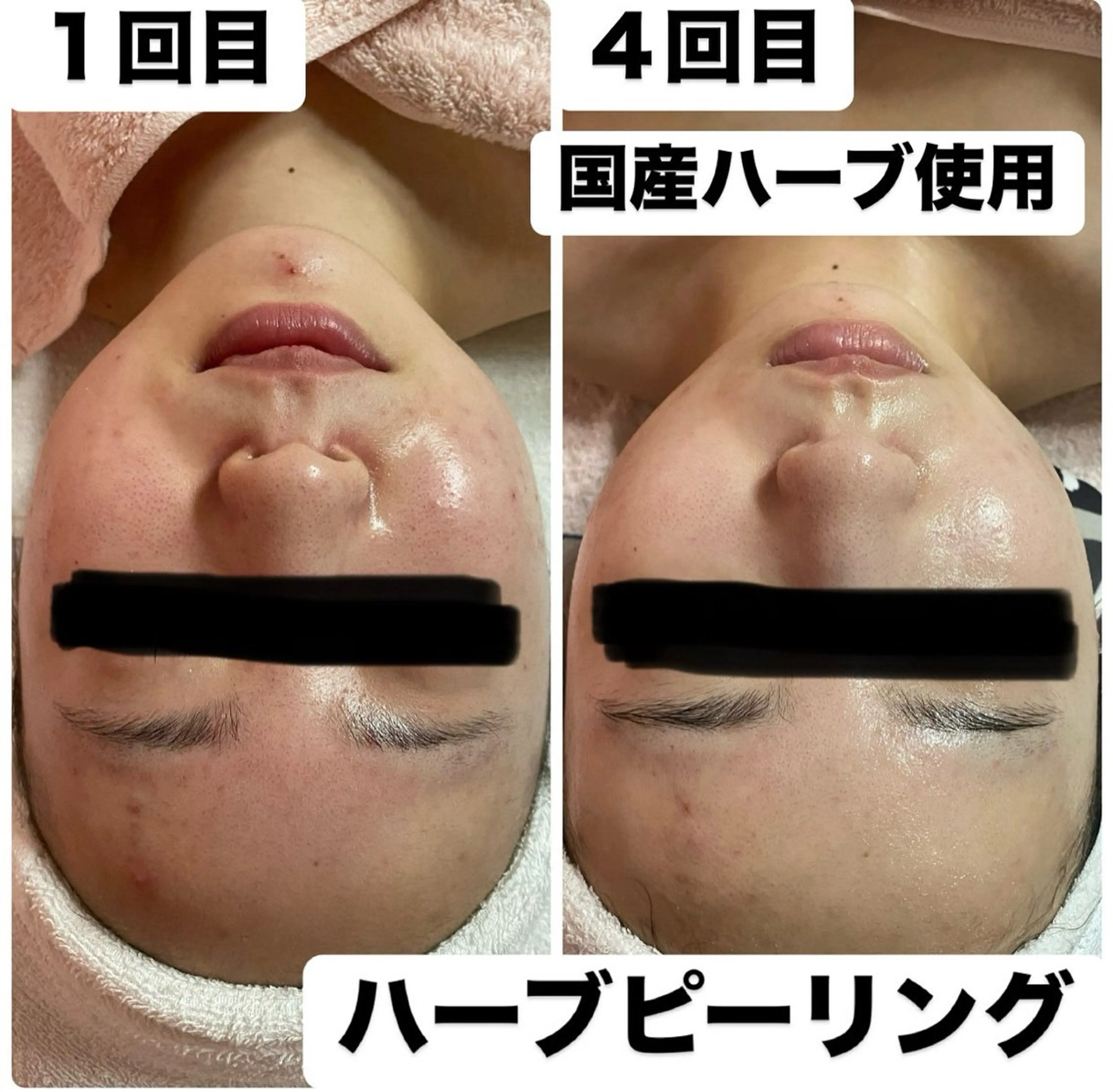 プラズマシャワー＋ハーブピーリング1g＋デコルテリンパ+ヒト幹細胞パックプラズマ導入の写真
