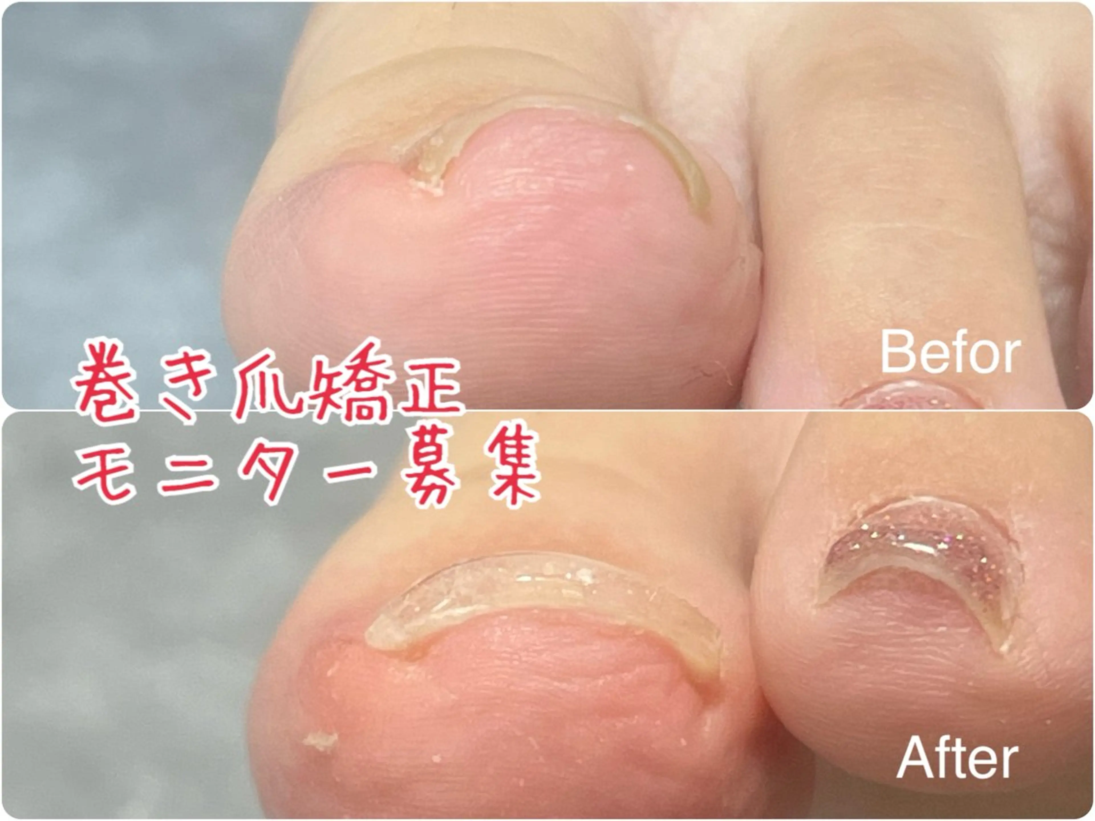 巻き爪矯正の写真