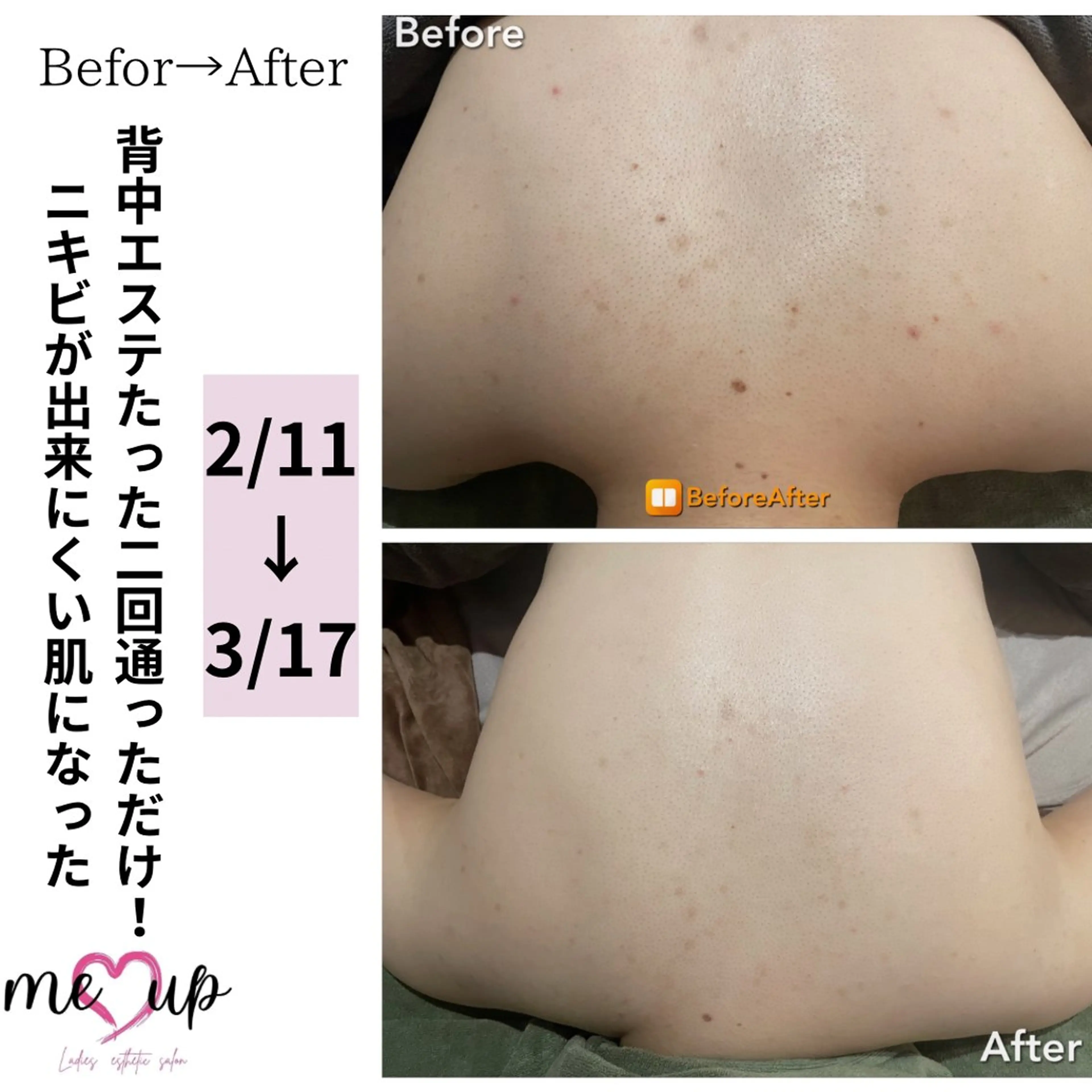 エステ Meupニキビ専門店 背中/ハーブ/ララのその他イメージ