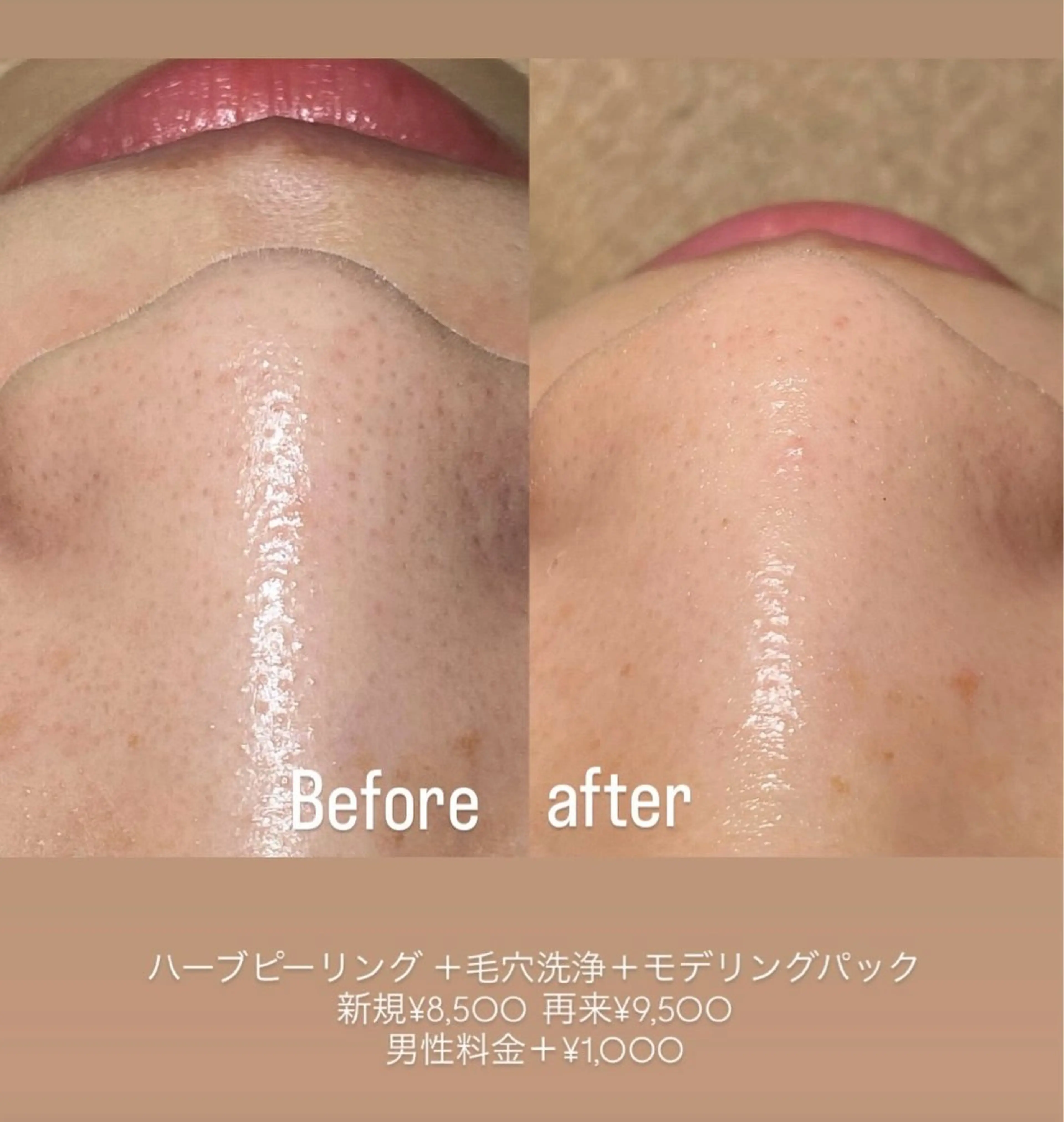 【練習モデル】毛穴洗浄×ハーブピーリング 60分¥8,500⇨¥4,900🌟［毛穴、ニキビ悩みはこれで完璧‼️］の写真
