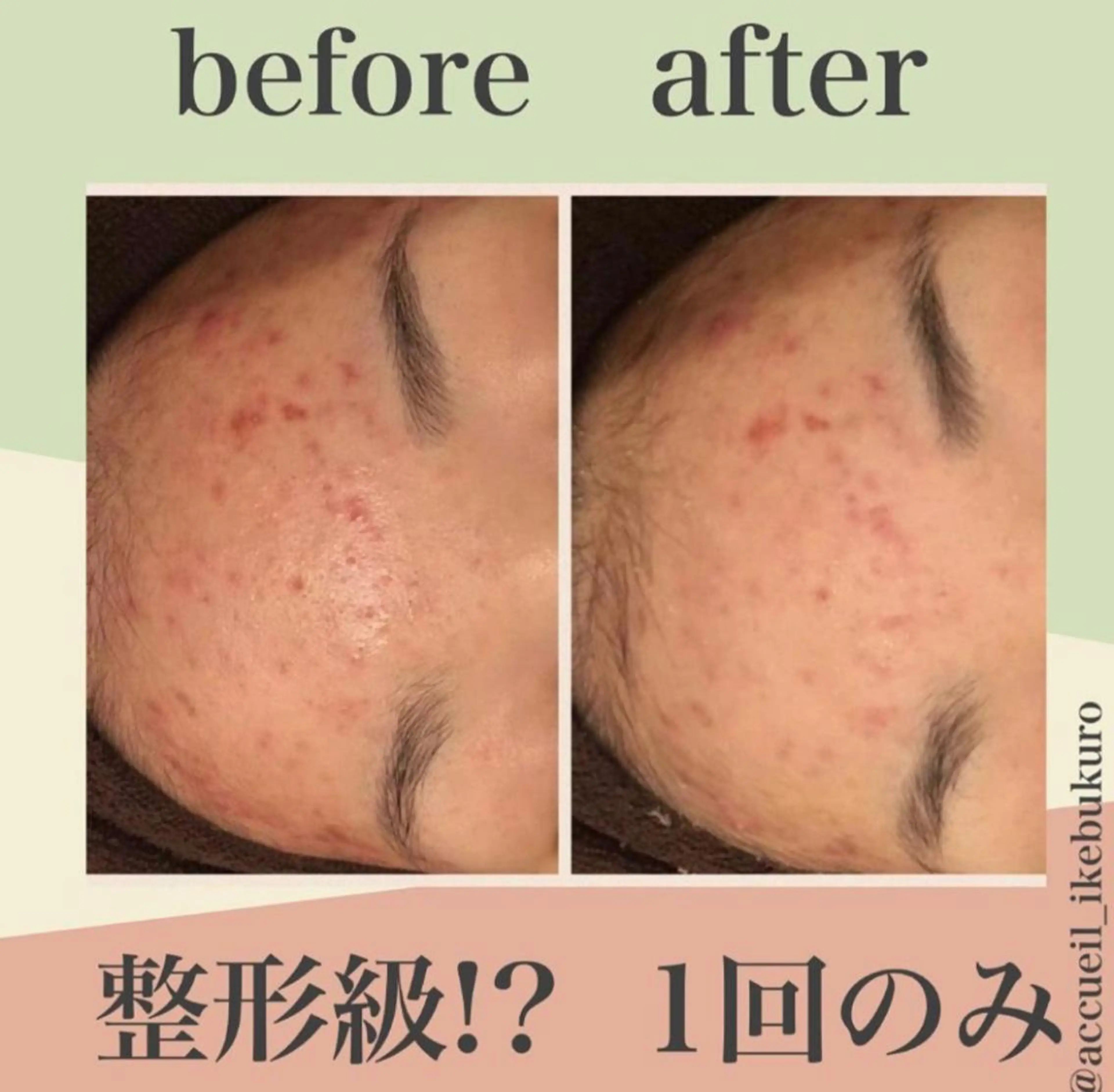 皮膚科より効果あり ⁉️最短ニキビ改善のエステ・リラクイメージ