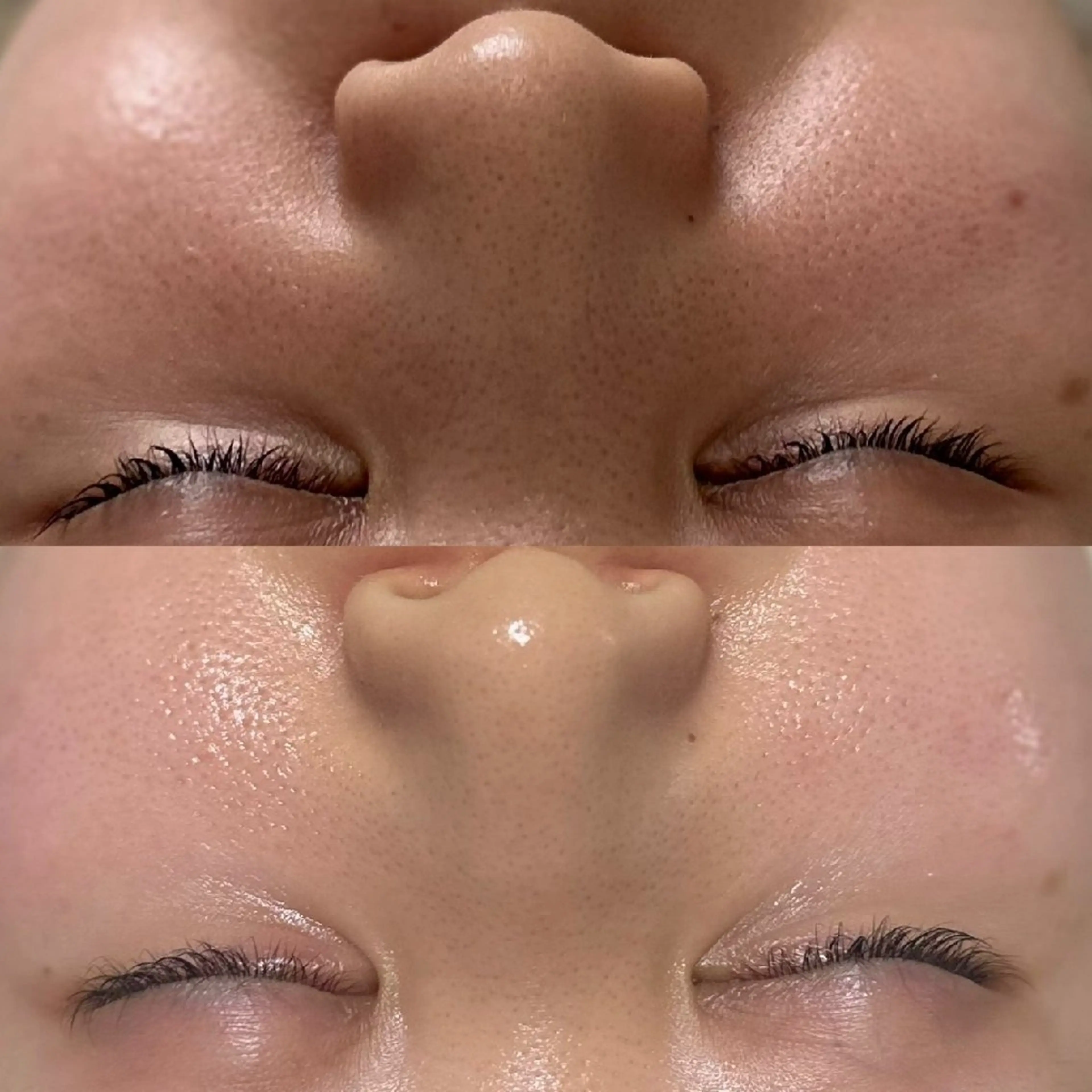 👑 【毛穴レス＆ツヤ肌】ハイドロ＆ラミネーション極上Wケアの写真