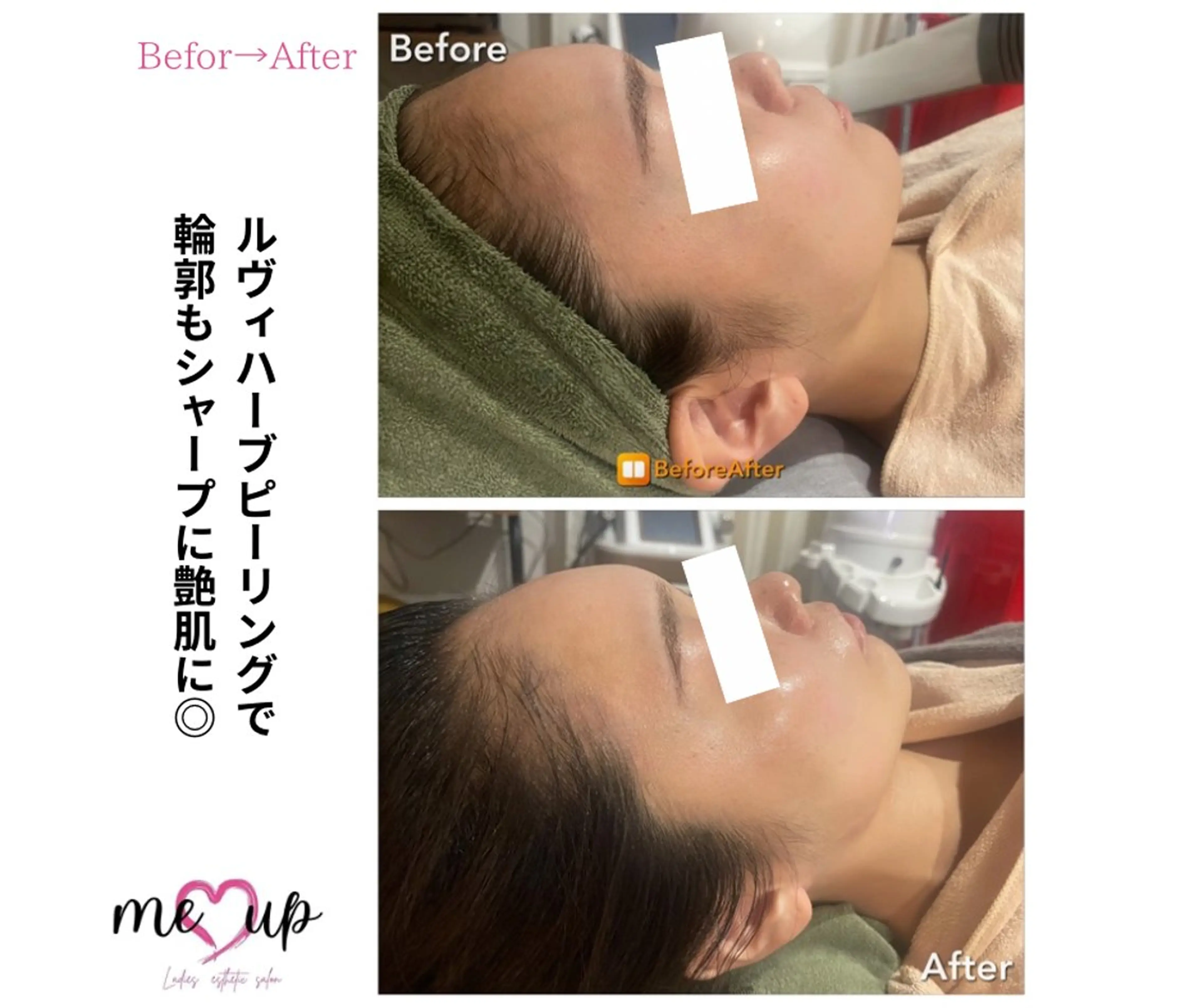 エステ Meupニキビ専門店 背中/ハーブ/ララのその他イメージ