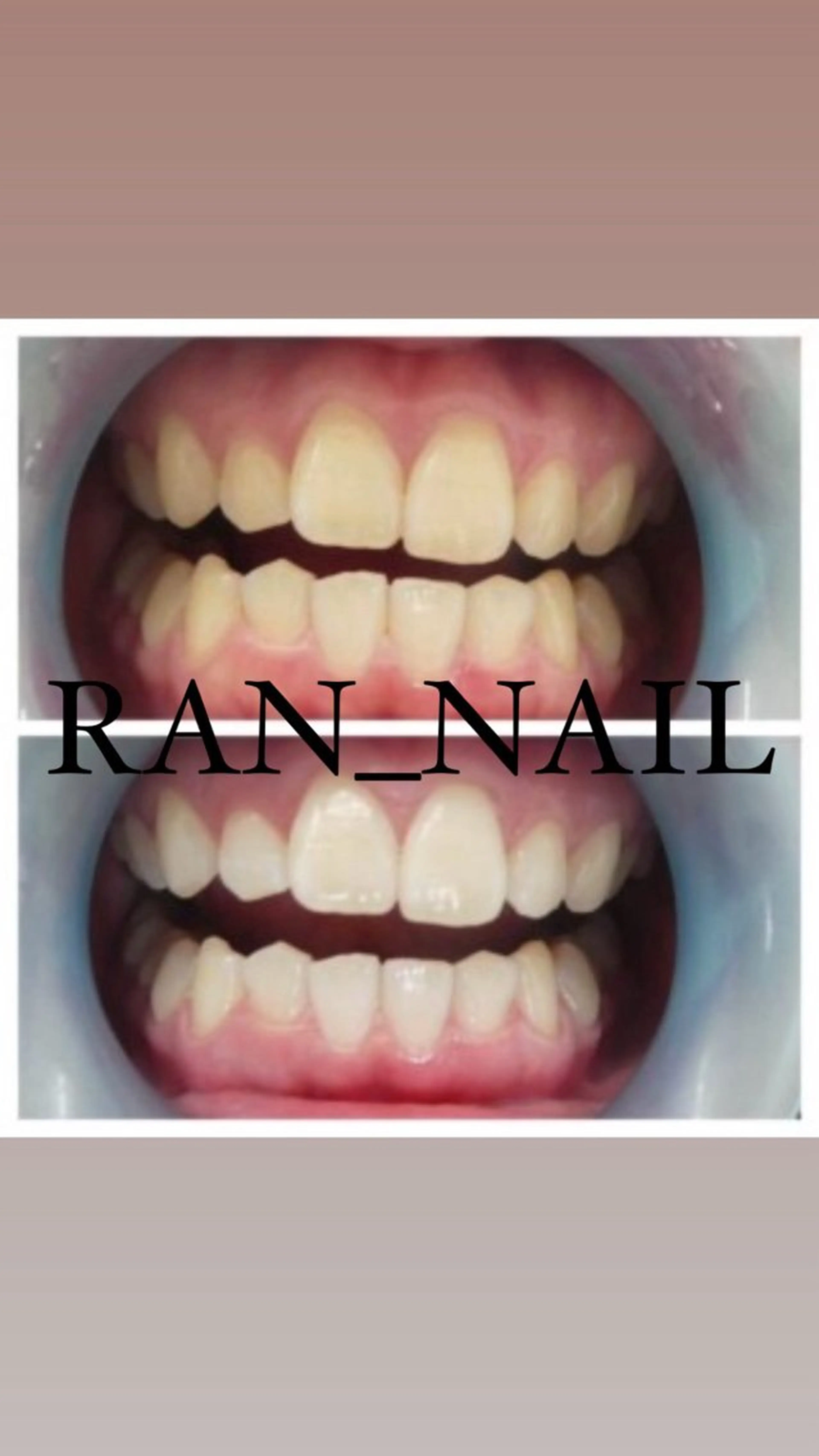 セルフホワイトニング🦷の写真