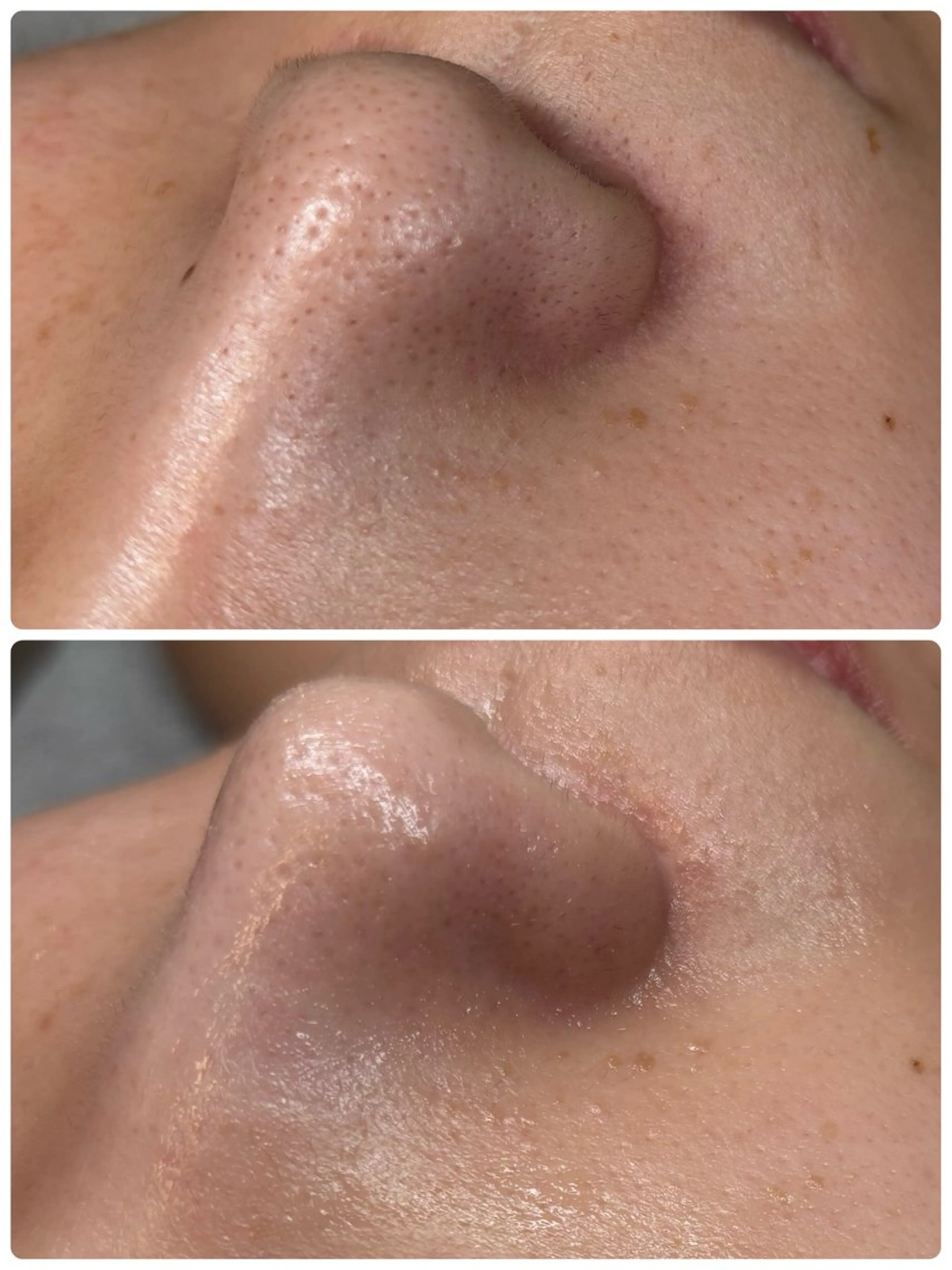 【 毛穴リセット 】毛穴洗浄＋ポレーション(専用パック付)|メンズおすすめの写真