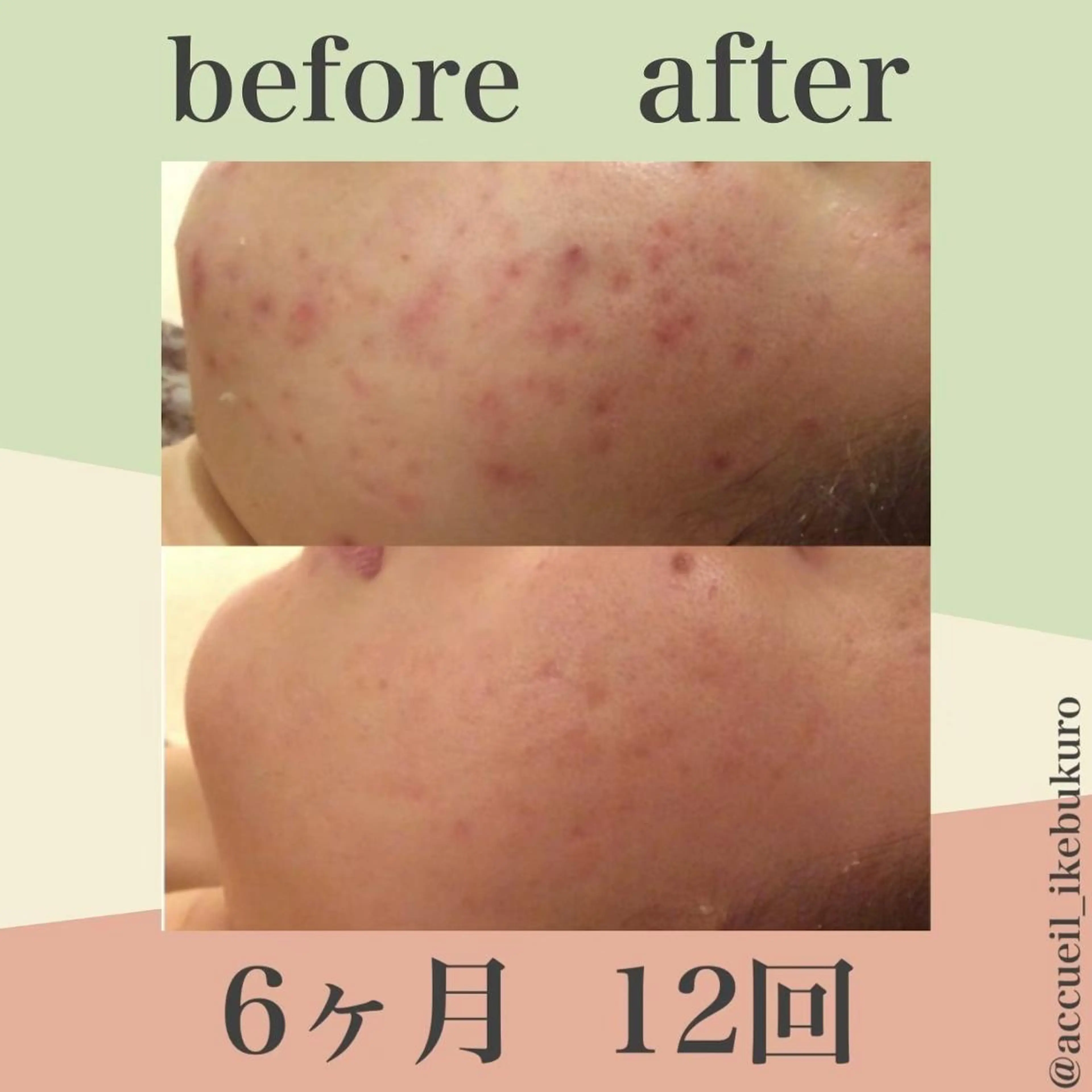 皮膚科より効果あり ⁉️最短ニキビ改善のエステ・リラクイメージ