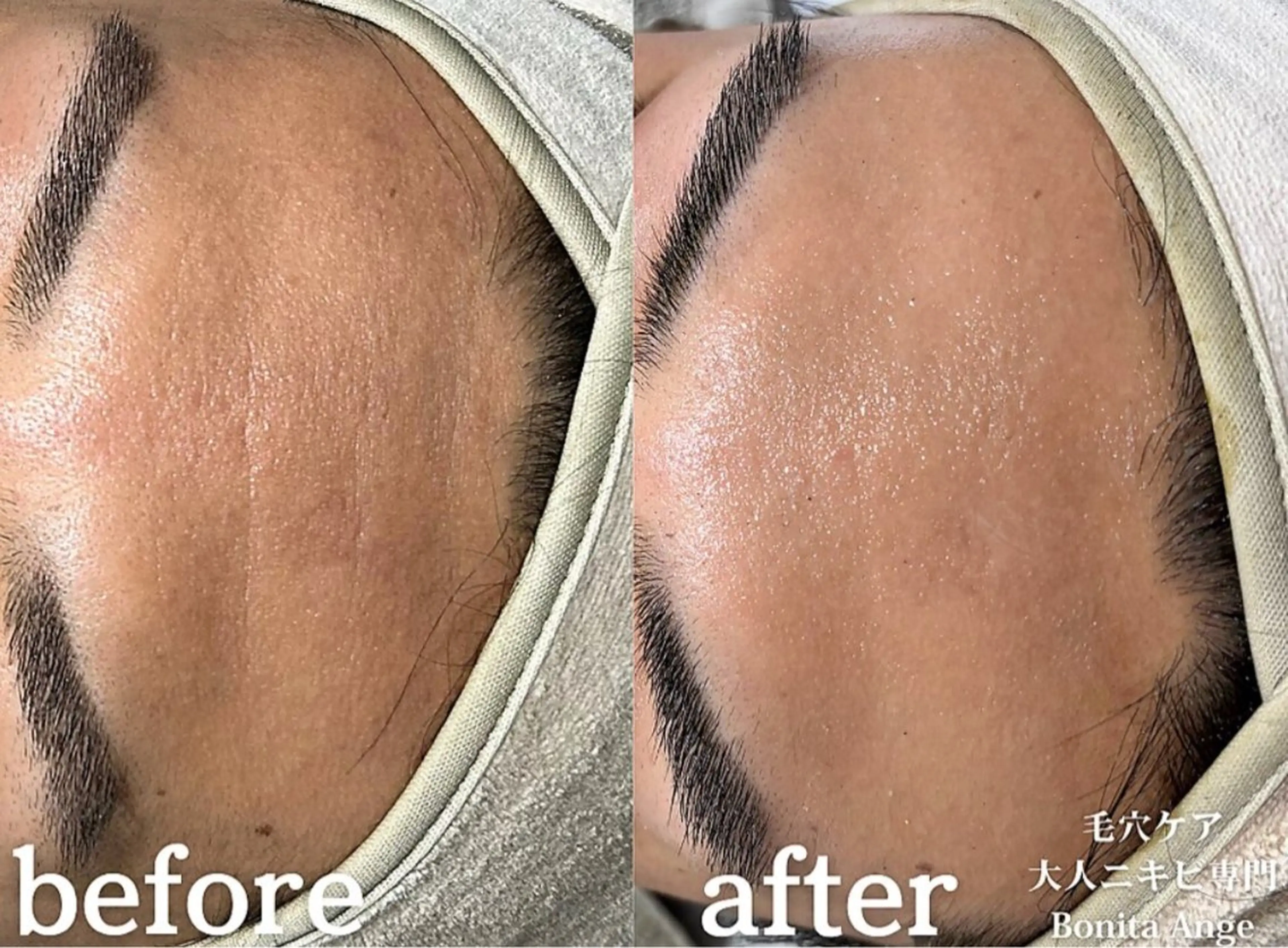 【メンズ初回/初回55%オフ】毛穴/大人ニキビ解決★調合式ハーブピーリング この冬モテたいメンズ集合⛄️🩵の写真