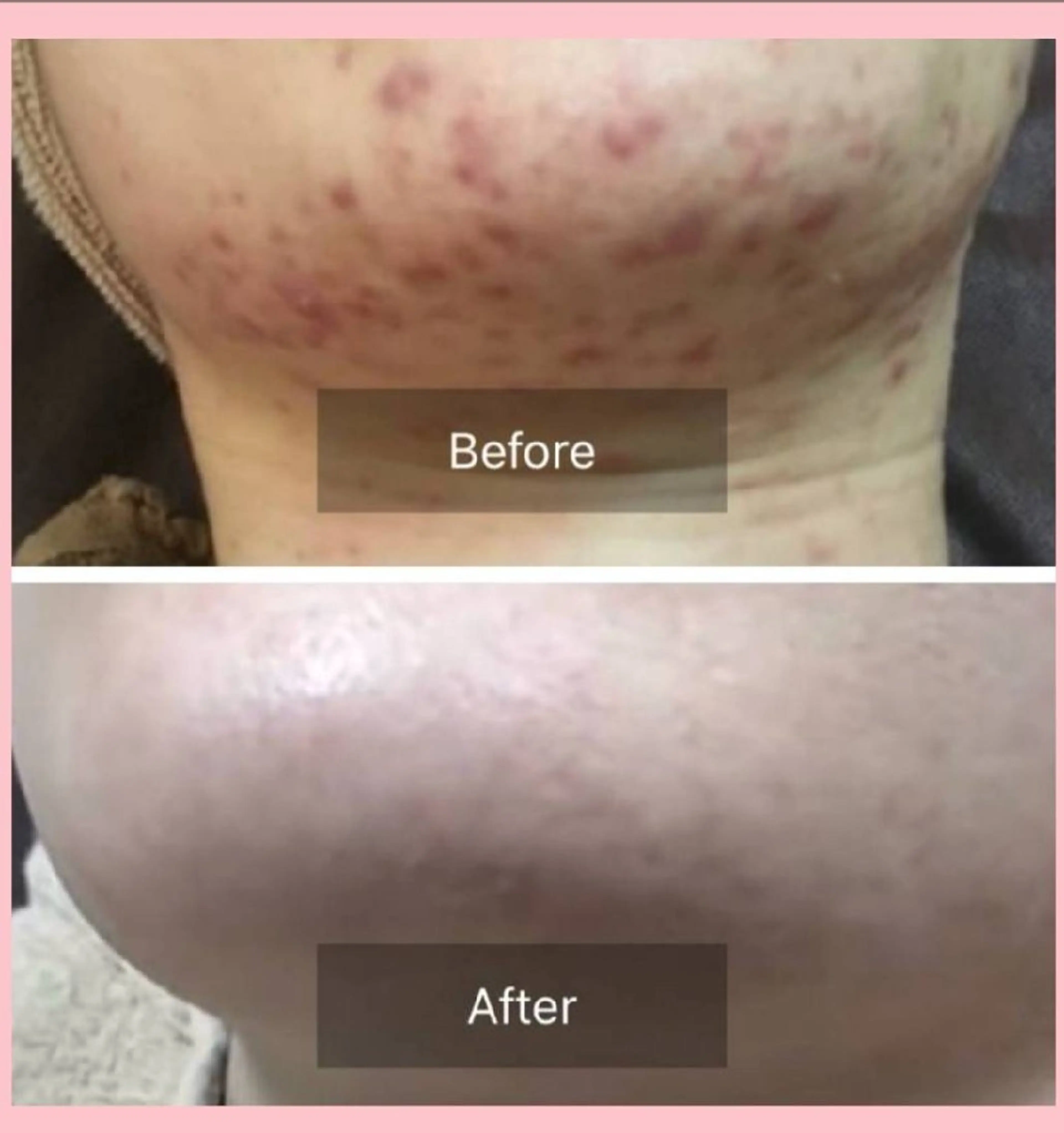 平日限定‼️フェイシャルハーブピーリングハード(剥離あり)🌿吹き出物、吹き出物の跡、毛穴、美白、黒ずみ、肌質ケアに🩷の写真