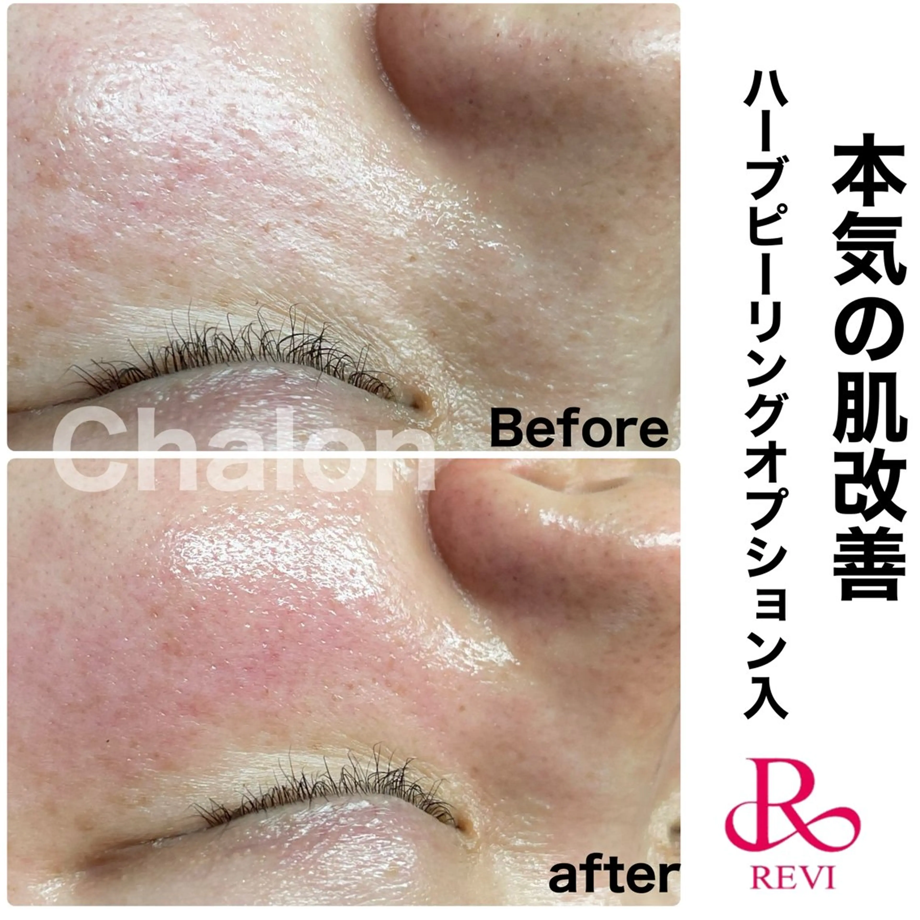 エステ Chalon所属・REVI取扱・肌悩み 改善　Chalonのエステ・リラクイメージ
