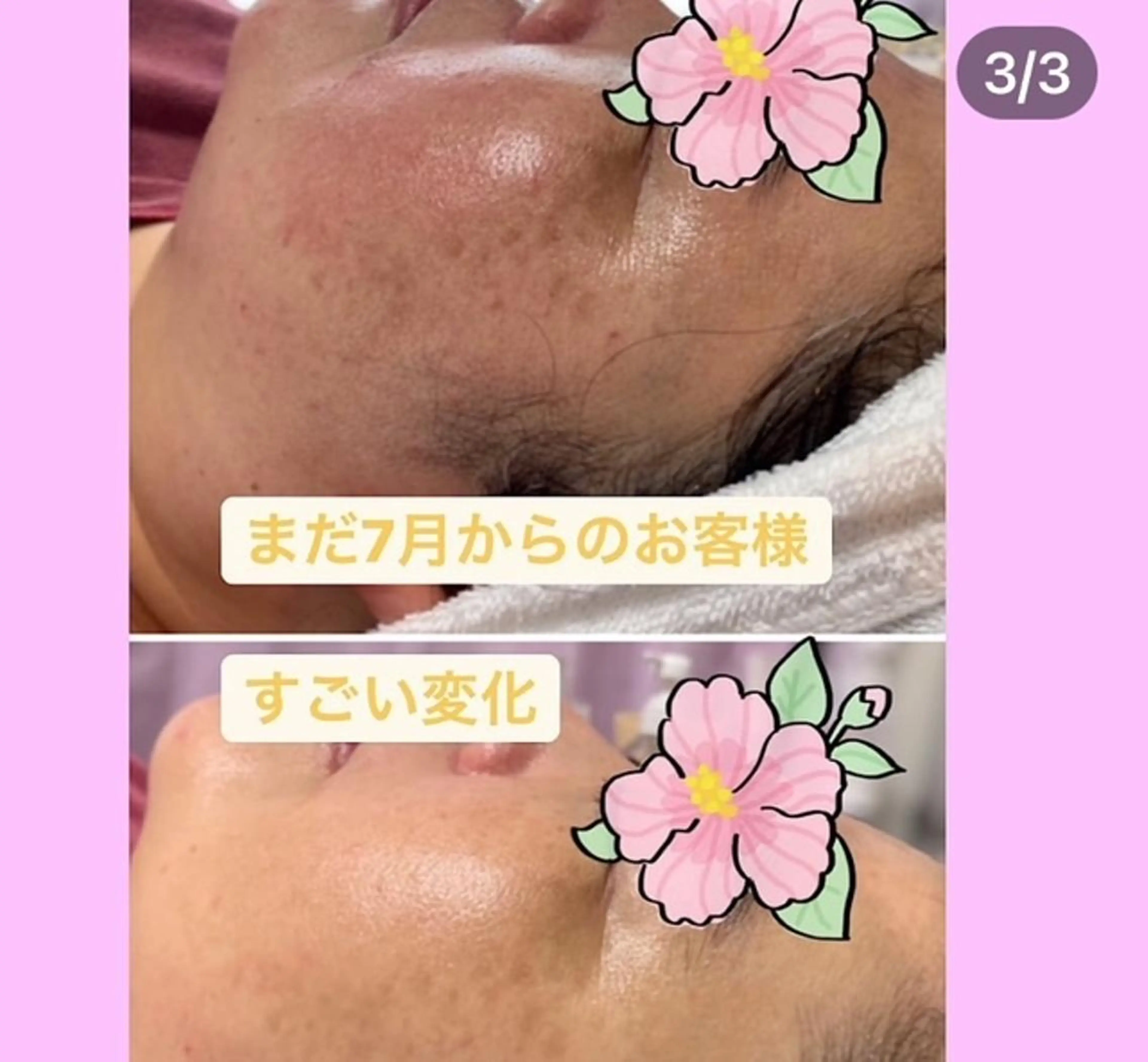 光肌質改善　光フォト　コース　しわ、シミ、たるみにケアの写真