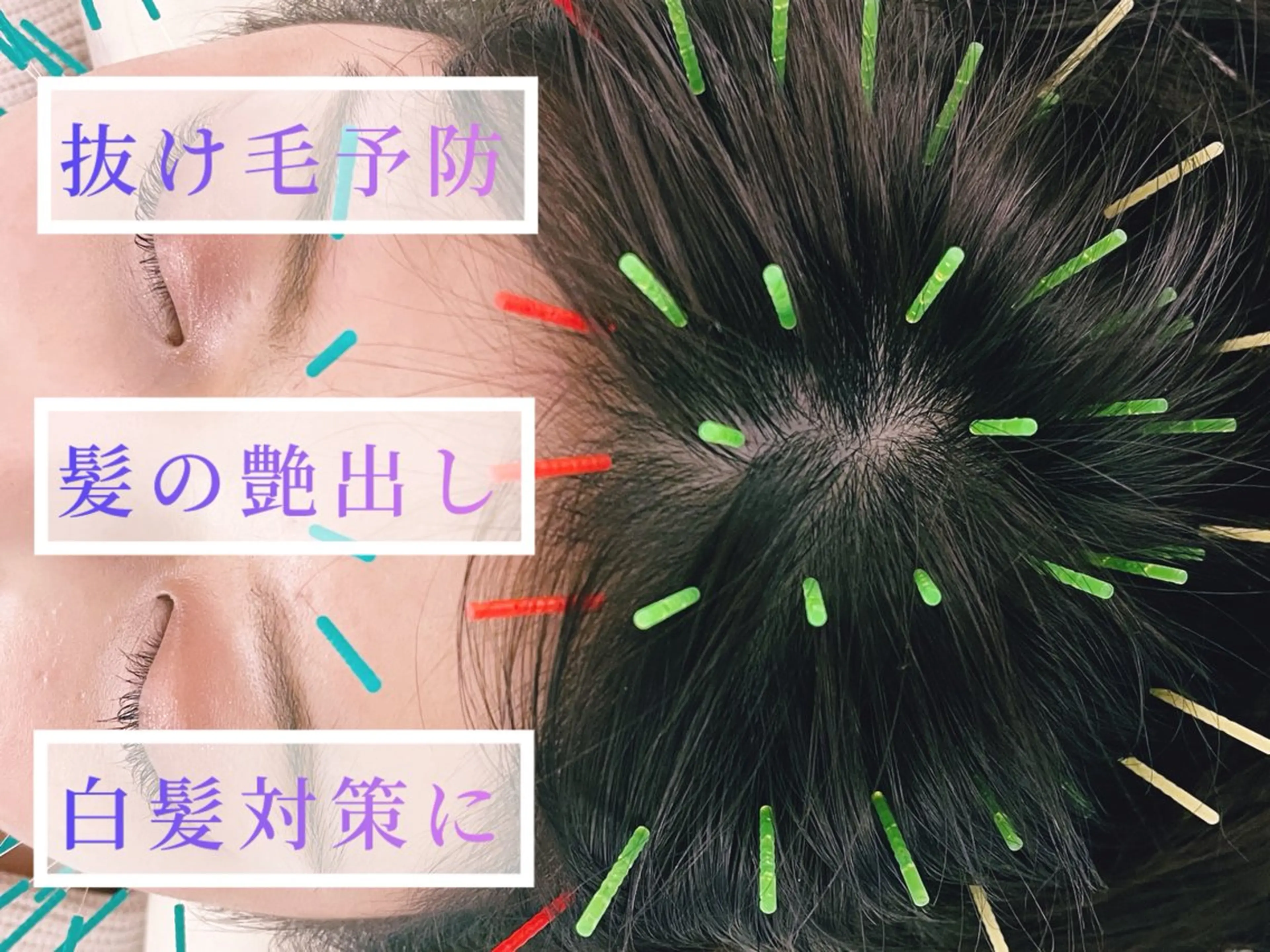 🔹ヘッドスパ鍼+リフトUP電気美容鍼🔹たるみケア・抜け毛予防・髪の艶出し・白髪対策にの写真