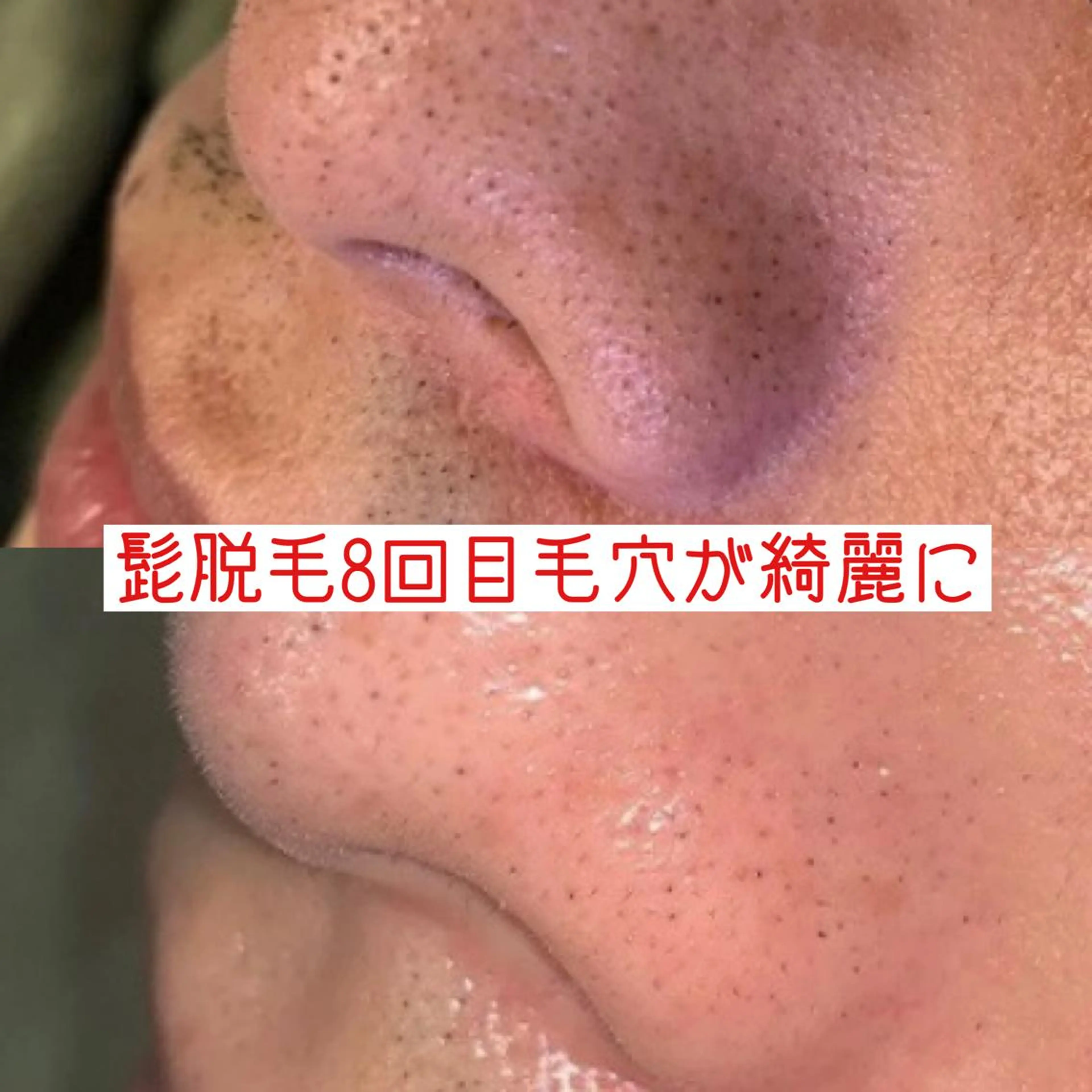 オアシス・さくら所属・中村貴子都度払い脱毛 小顔コルギのエステ・リラクイメージ