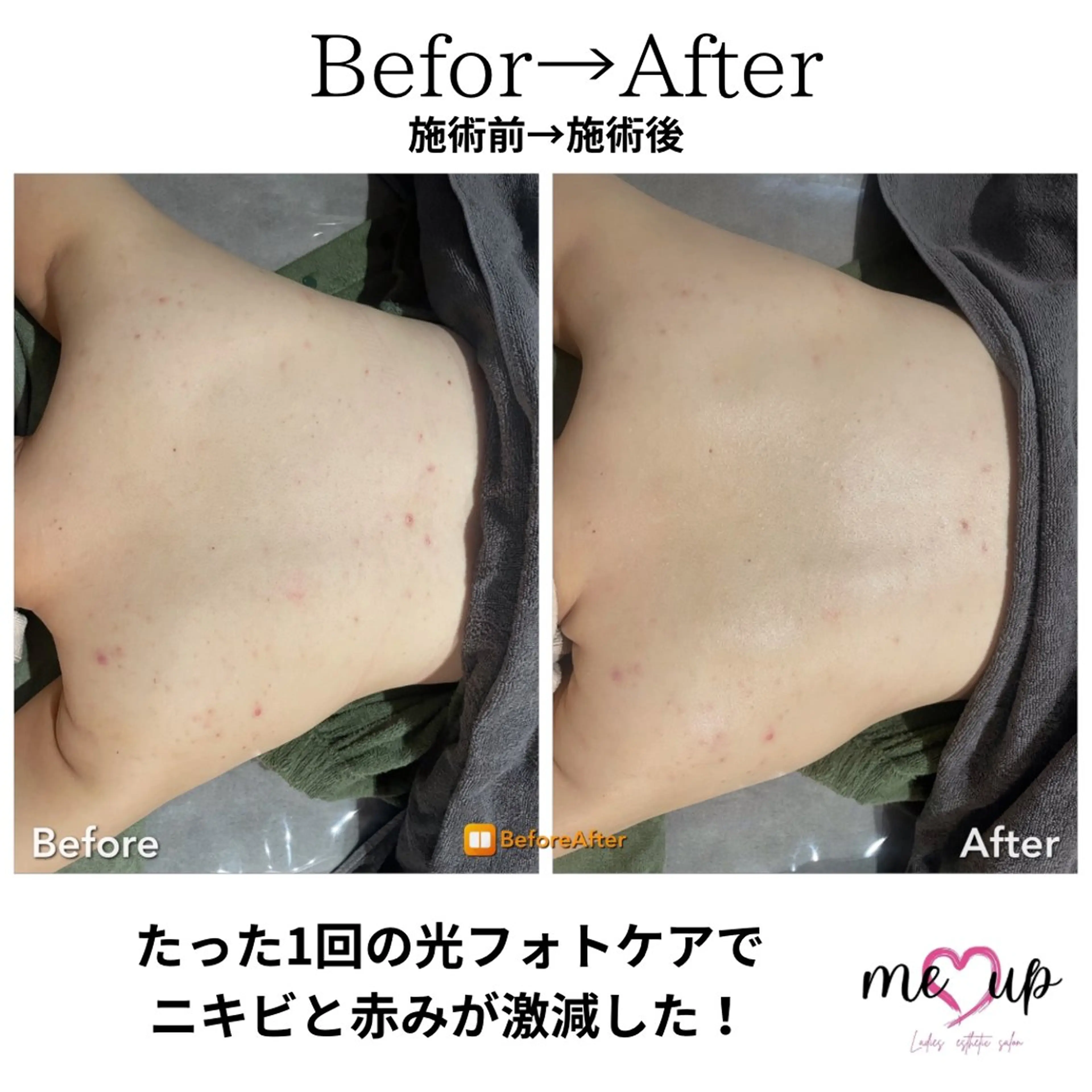 エステ Meupニキビ専門店 背中/ハーブ/ララのその他イメージ