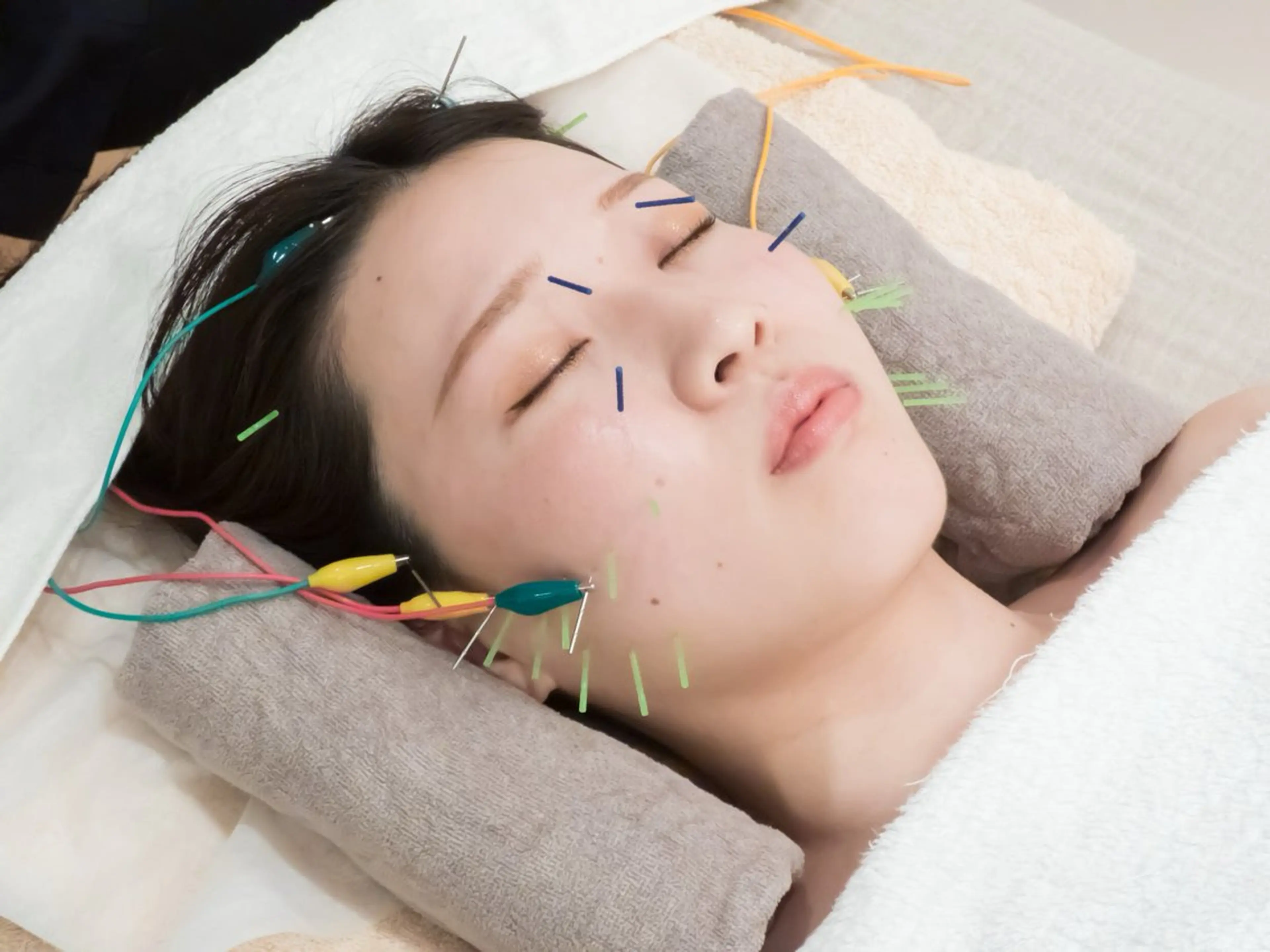 【美容鍼お試しコース】初めての方でも安心🎀痛みの少ないクイック電気美容鍼60分¥9,900→¥3,900の写真