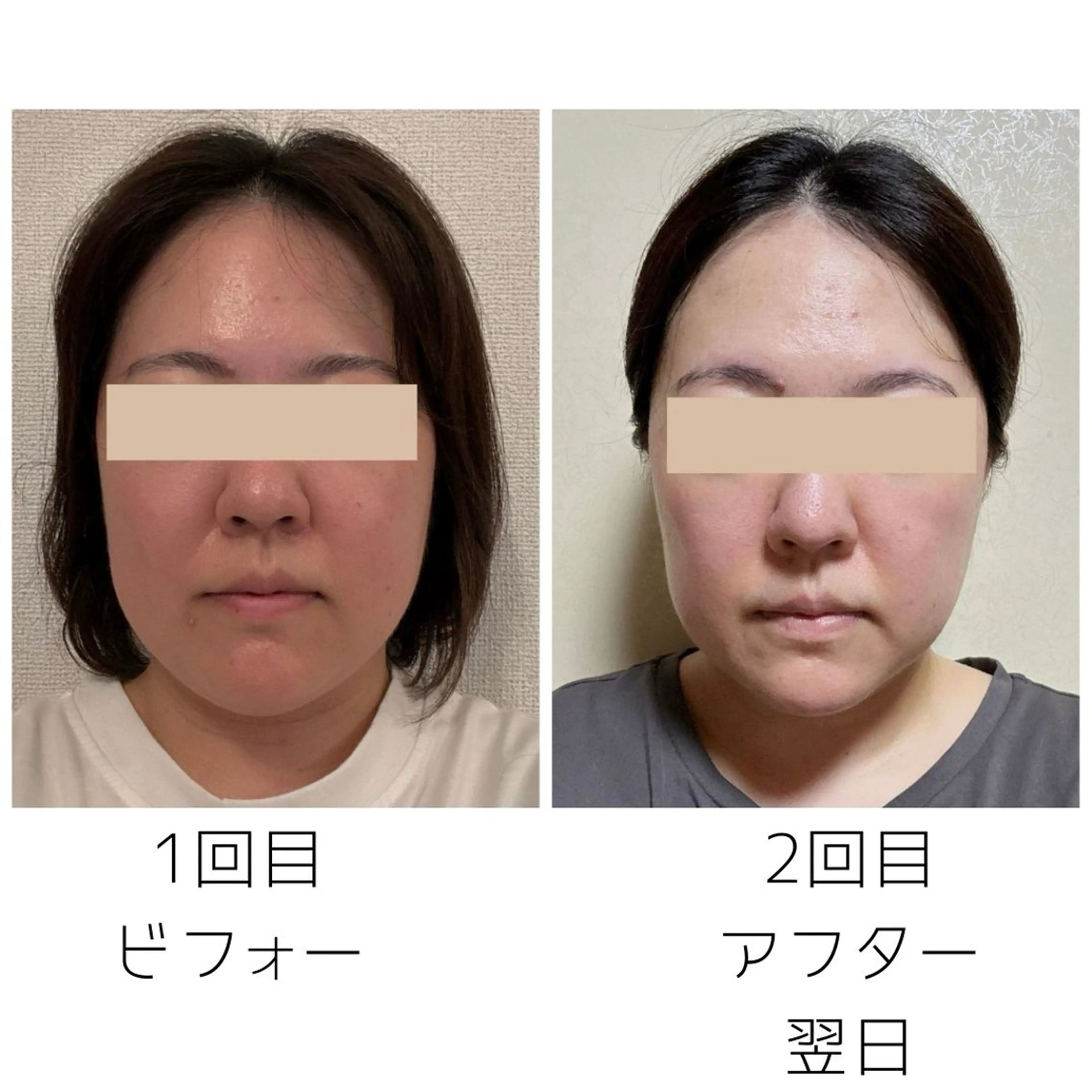 小顔矯正5回モニター　初回滞在約90分※注意事項を必読の上、ご予約くださいの写真
