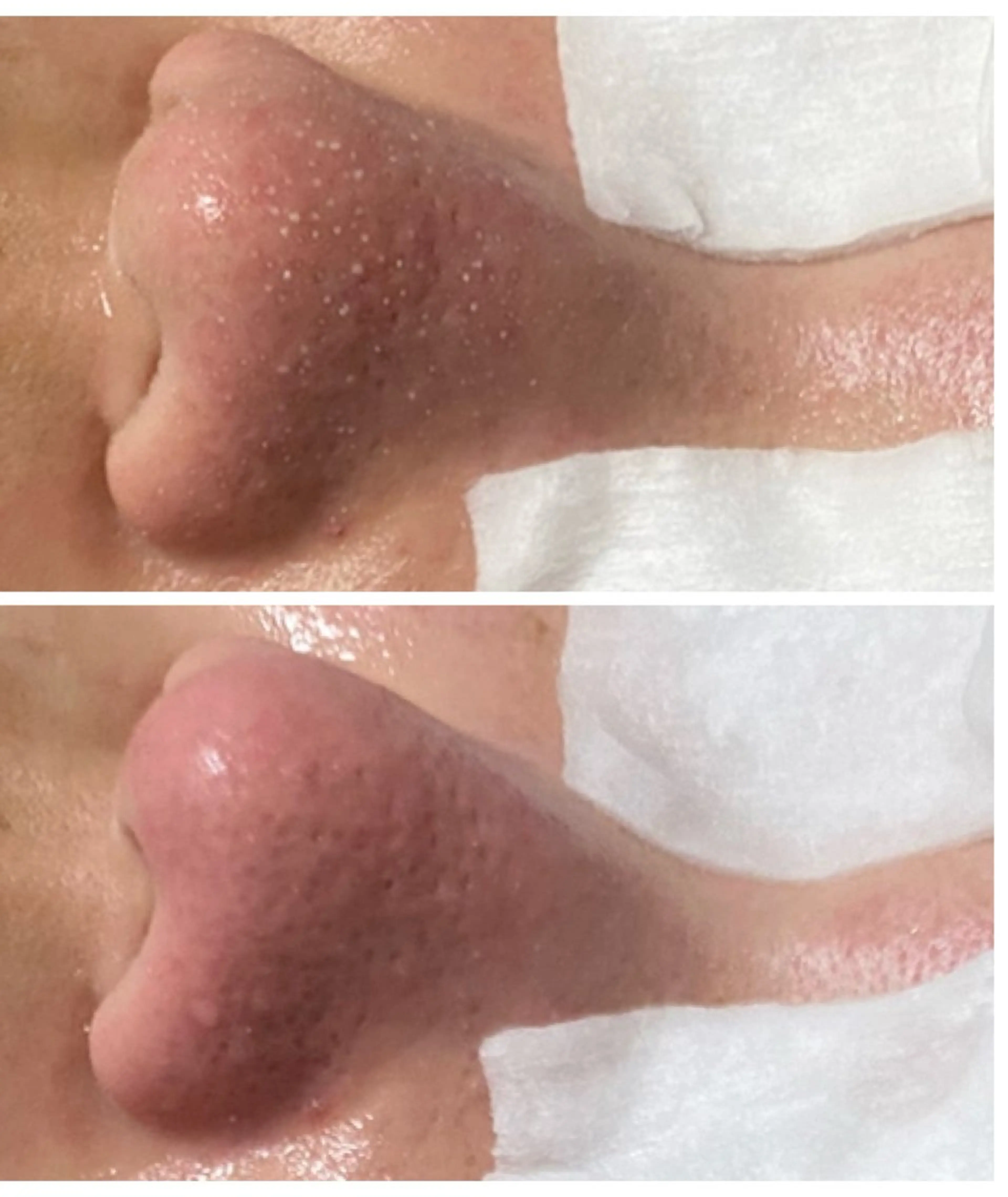 黒ずみさよなら！つるつる毛穴コース　いちご鼻もスッキリ！30分の写真