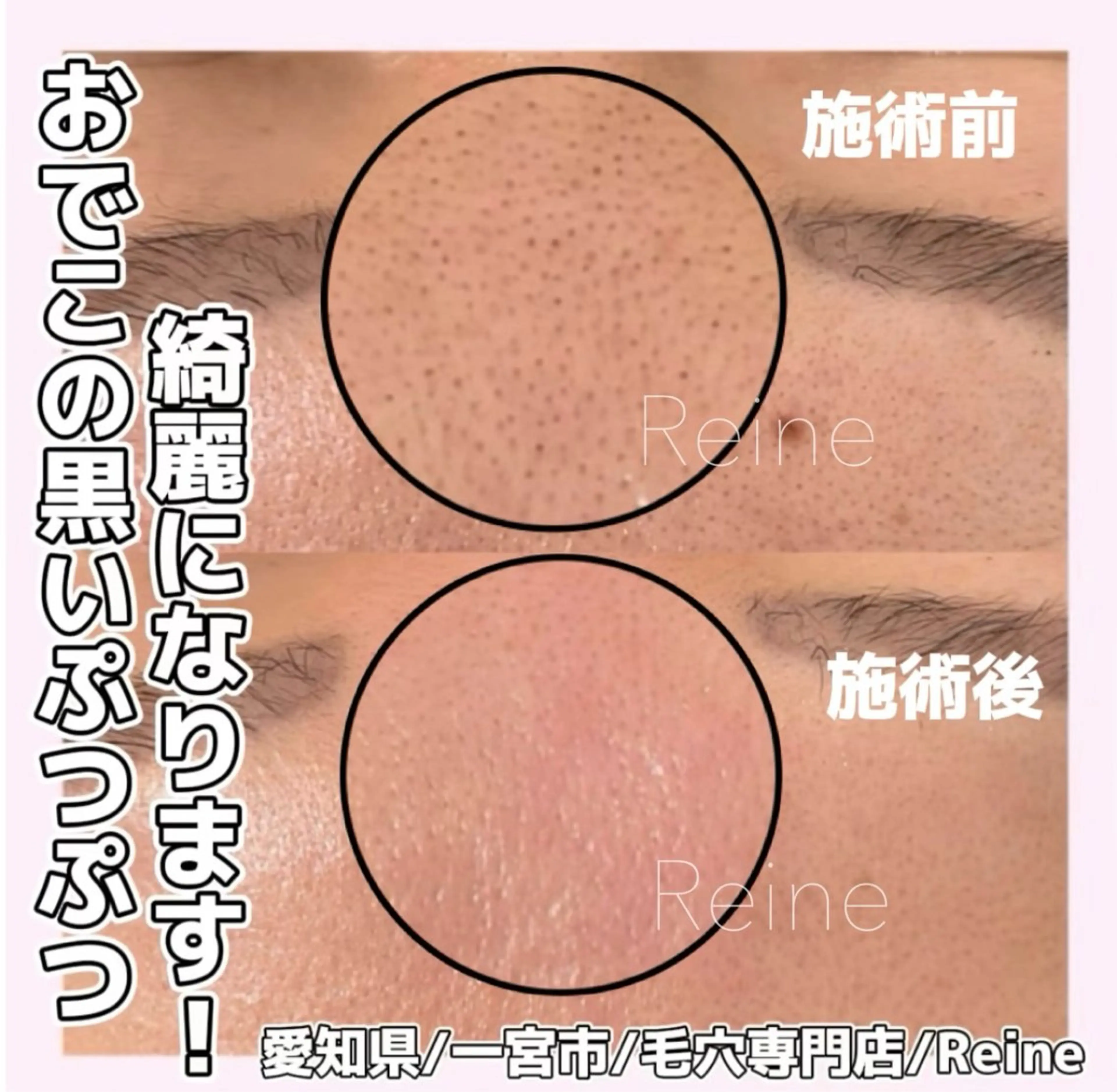 エステ Reine BeautySalon所属・毛穴/シミ肝斑/脱毛 横山梨里のエステ・リラクイメージ