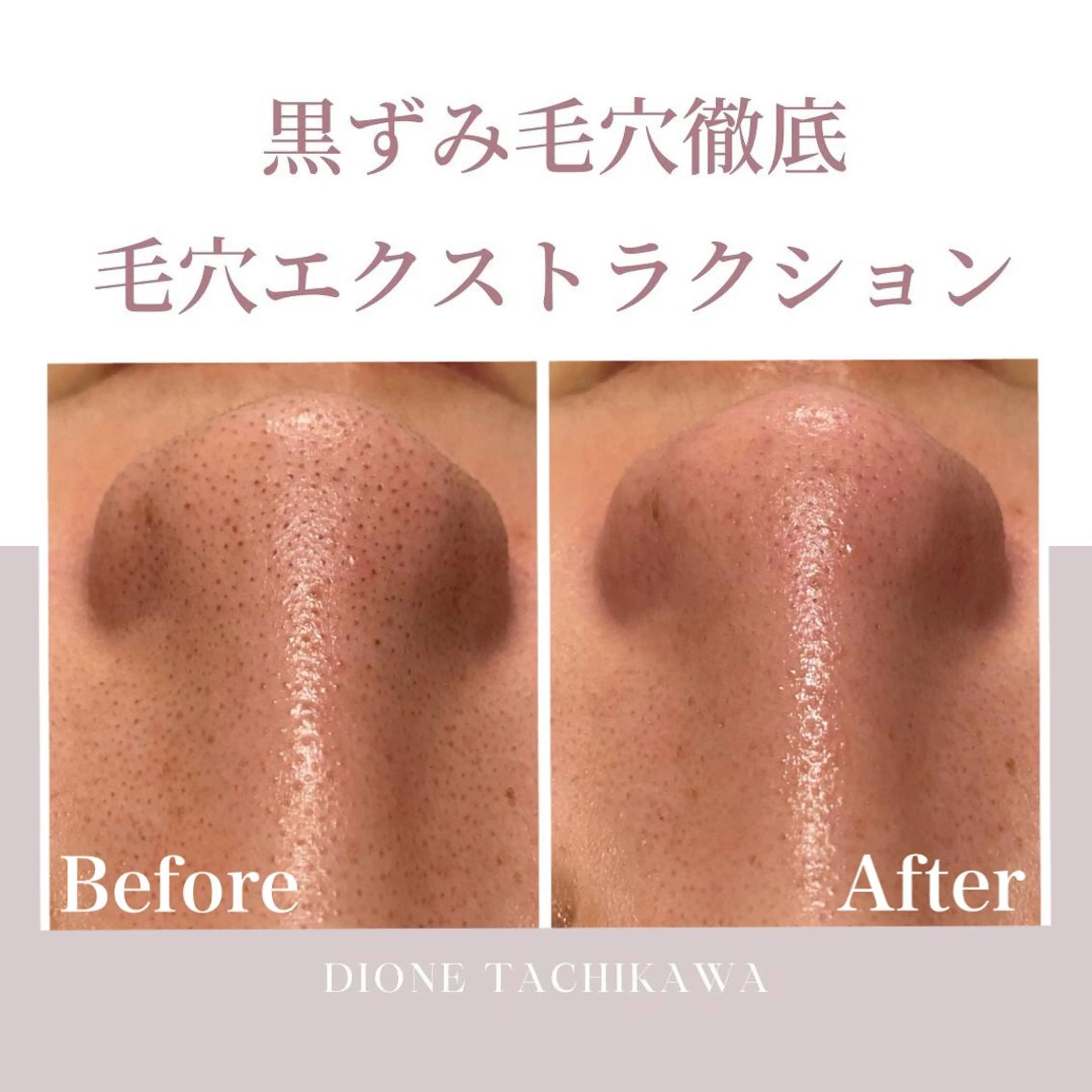 エステ 【リベルハーブピーリング認定店】敏感肌・美白脱毛専門店Dione立川店所属・Dione 立川店のエステ・リラクイメージ